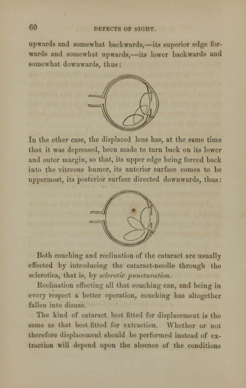 00 upwards and somewhat backward!,—Ita superior edge for- wards and somewhat upwards,—its lower backwards and somewhat downwards, thus: Tn the other case, the displaced lens lias, at the svnne time that it was depressed, been made to turn hack on its lower and outer margin, so that, its upper edge being foroed back into the vitreous humor, its anterior surface comes to be uppermost, its posterior surface directed downwards, thus: Until couching and reclination of the cataract arc usually effected by introducing the cataract-needle through the sclerotica, that is, by tclerotic puncturatton. I! olination effecting all that couching can, and being in respect u better operation, couching has altogether fallen into di-i The kind of cataract best fitted for displacement is the same ss that best fitted lor extraction. Whether or not therefore displacemenl Bhould he performed instead ot traction will depend upon the ahsence of the condit