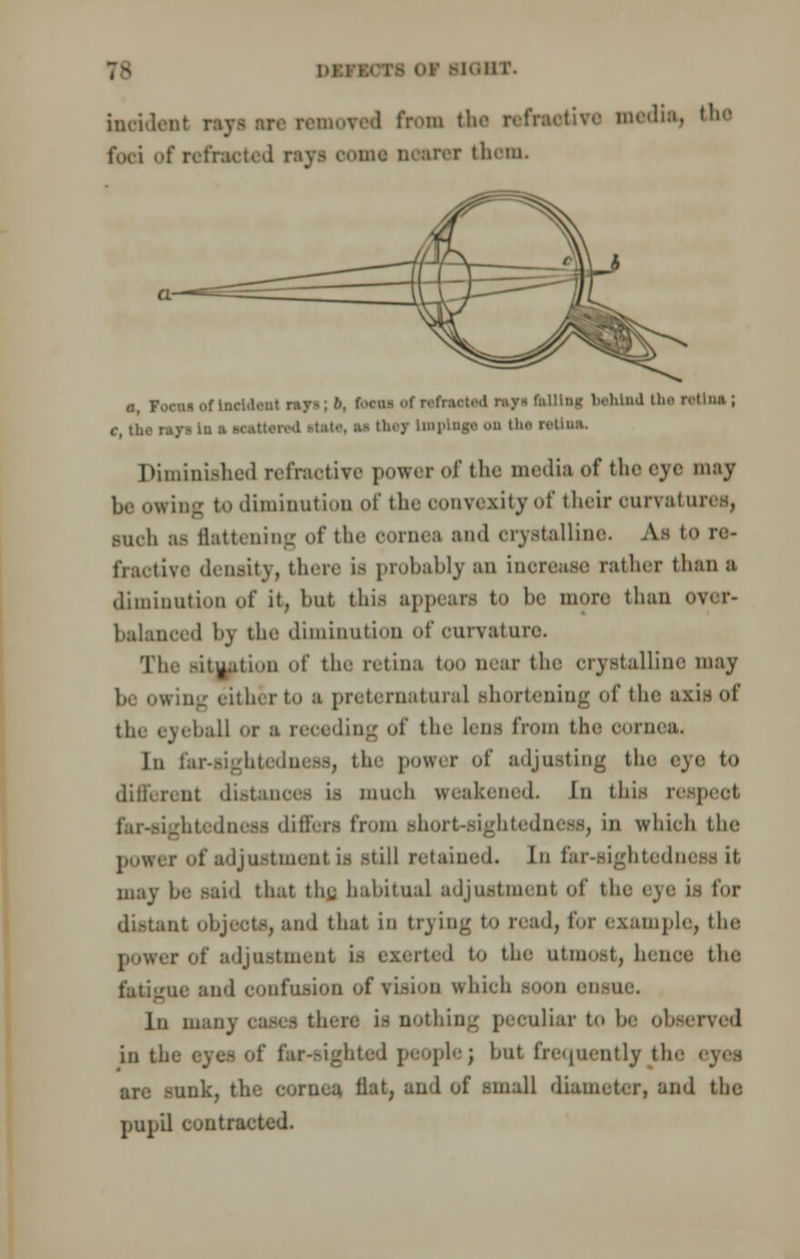 7^ .ni'. incident r moved from the refractive madia, the fori of refracted rayi oomt nearer them, a, foem of Incident rays; 6, r»cu- of refracted rayi hlllnj behind the ntlu; C, tho ra}> la a Matt, i M I1' Wtln*. Diminished refractive power of the media of the eye may be owing to diminution of the convexity of their ourvaturee, .-mh as flattening of the oornea and crystalline. As i re- fractive density, there is probably an inoretise rather than a diminution of it, but this appears to be more than over- balanced bj the diminution of curvature. The situation dt' the retina too near the crystalline may be owing either to a preternatural shortening of the axis of the eyeball or a receding of the lens from the cornea. In far-sightedness, the power of adjusting the eye to different distance is much weakened. In this respect far-sightedness differs from short-sightedness, in which the power of adjustment is still retained. Iii far-sightedni may be said that thy habitual adjustment of tin- eye is for distant objects, and that in trying to read, tor example, the power of adjustment is exerted to the utmost, henoe the. fatigue and confusion of vision which boou ei In many case-tie . thing peculiar to b< in the eyes of far-sighted people; but frequently tie are sunk, the cornea Hat, and of small diameter, and the pupil cuntracted.