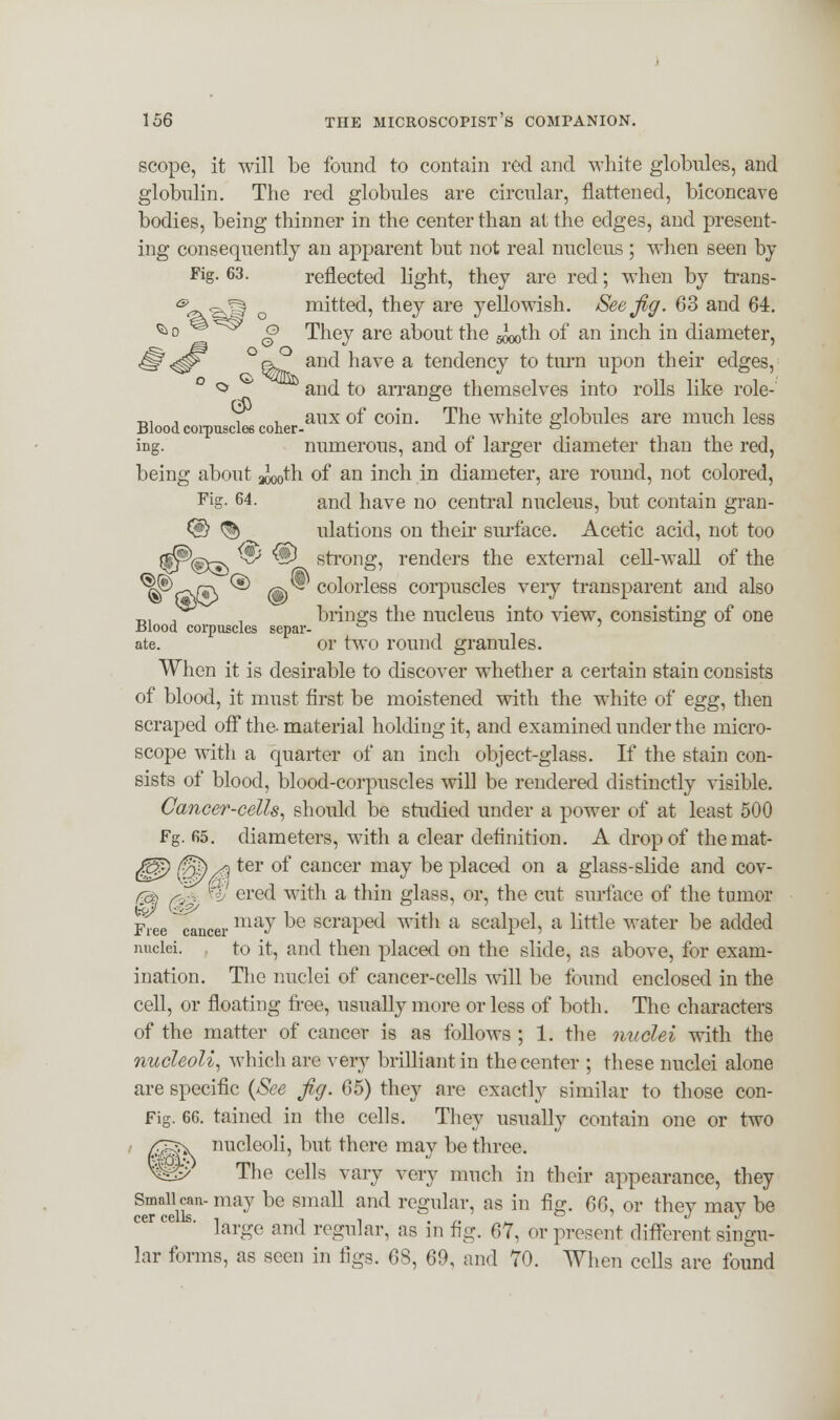 scope, it will be found to contain red and white globules, and globulin. The red globules are circular, flattened, biconcave bodies, being thinner in the center than at the edges, and present- ing consequently an apparent but not real nucleus ; when seen by Fig. 63. reflected light, they are red; when by trans- * «gj| o mitted, they are j^ellowish. See fig. 63 and 64. ^ o *® o They are about the ^th of an inch in diameter, and have a tendency to turn upon their edges, and to arrange themselves into rolls like role- ,,, , ii aux of coin. The Avhite globules are much less Blood corpuscles coher- D ing. numerous, and of larger diameter than the red, being about ^th. of an inch in diameter, are round, not colored, Fig- 64- and have no central nucleus, but contain gran- © % ulations on their surface. Acetic acid, not too ^,sw ^ ® strong, renders the external cell-wall of the H^f\R> ^ d> co^orless corpuscles very transparent and also _, , , brings the nucleus into view, consisting of one JBlood corpuscles scpar- ° 7 ate. or two round granules. When it is desirable to discover whether a certain stain consists of blood, it must first be moistened with the white of egg, then scraped off the- material holding it, and examined under the micro- scope with a quarter of an inch object-glass. If the stain con- sists of blood, blood-corpuscles will be rendered distinctly visible. Cancer-cells, should be studied under a power of at least 500 Fg. fi5. diameters, with a clear definition. A drop of themat- ££$) (5%x\ ter of cancer may be placed on a glass-slide and cov- m 0p Hi ered with a thin glass, or, the cut surface of the tumor Free cancer m2^ ^e scraPe(l ™&* a scalpel, a little water be added nuclei. to it, and then placed on the slide, as above, for exam- ination. The nuclei of cancer-cells will be found enclosed in the cell, or floating free, usually more or less of both. The characters of the matter of cancer is as follows ; 1. the nuclei with the nucleoli, which are very brilliant in the center ; these nuclei alone are specific {See fig. 65) they are exactly similar to those con- Fig. 66. tained in the cells. They usually contain one or two nucleoli, but there may be three. The cells vary very much in their appearance, they Small can- may be small and regular, as in fig. 66, or they may be large and regular, as in fig. 67, or present different singu- lar forms, as seen in tigs. 68, 69, and 70. When cells are found