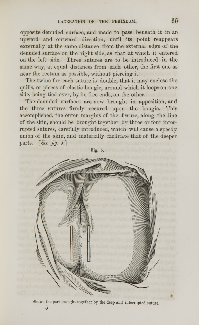 opposite denuded surface, and made to pass beneath it in an upward and outward direction, until its point reappears externally at the same distance from the external edge of the denuded surface on the right side, as that at which it entered on the left side. Three sutures are to be introduced in the same way, at equal distances from each other, the first one as near the rectum as possible, without piercing it. The twine for each suture is double, that it may enclose the quills, or pieces of elastic bougie, around which it loops on one side, being tied over, by its free ends, on the other. The denuded surfaces are now brought in apposition, and the three sutures firmly secured upon the bougie. This accomplished, the outer margins of the fissure, along the line of the skin, should be brought together by three or four inter- rupted sutures, carefully introduced, which will cause a speedy union of the skin, and materially facilitate that of the deeper parts. [See Jig. 5.] Fig. 5. Shows the part brought together by the deep and interrupted suture 5