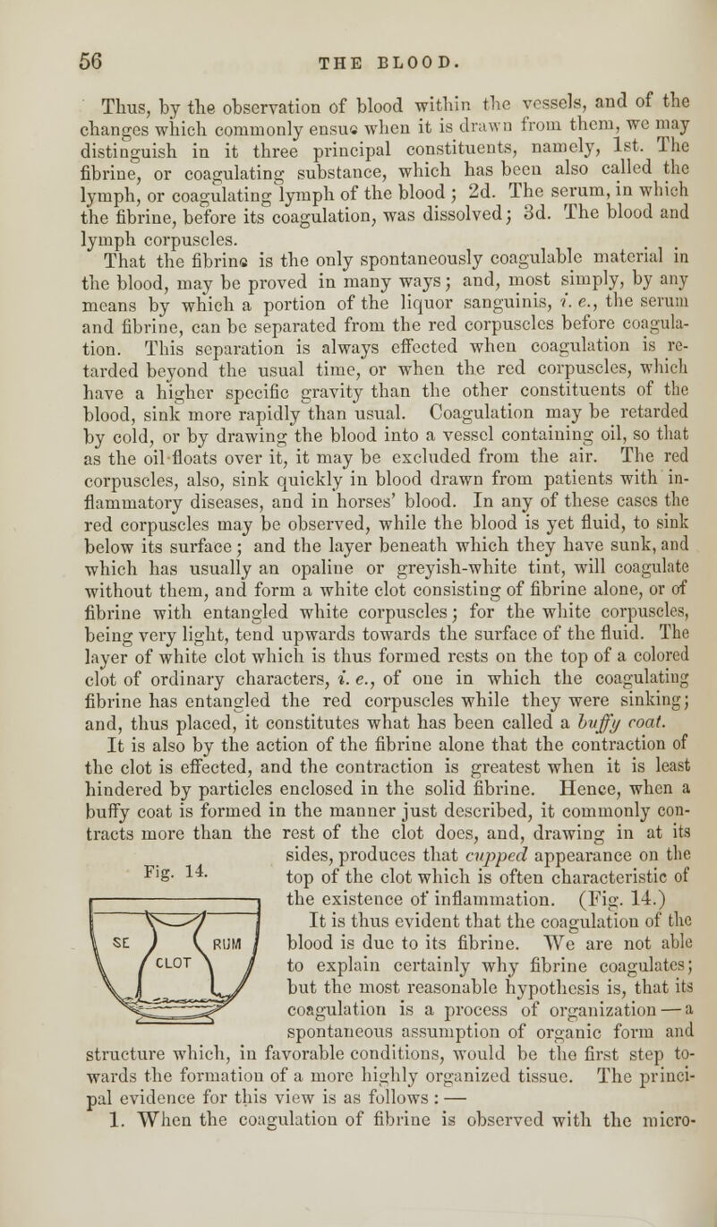 Thus, by the observation of blood within the vessels, and of the changes which commonly ensu« when it is drawn from them, we may distinguish in it three principal constituents, namely, 1st. The fibrine, or coagulating substance, which has been also called the lymph, or coagulating'lymph of the blood i 2d- The serum'in which the fibrine, before its coagulation, was dissolved; 3d. The blood and lymph corpuscles. That the fibrins is the only spontaneously coagulable material in the blood, may be proved in many ways; and, most simply, by any means by which a portion of the liquor sanguinis, i.e., the serum and fibrine, can be separated from the red corpuscles before coagula- tion. This separation is always effected when coagulation is re- tarded beyond the usual time, or when the red corpuscles, which have a higher specific gravity than the other constituents of the blood, sink more rapidly than usual. Coagulation may be retarded by cold, or by drawing the blood into a vessel containing oil, so that as the oil floats over it, it may be excluded from the air. The red corpuscles, also, sink quickly in blood drawn from patients with in- flammatory diseases, and in horses' blood. In any of these cases the red corpuscles may be observed, while the blood is yet fluid, to sink below its surface ; and the layer beneath which they have sunk, and which has usually an opaline or greyish-white tint, will coagulate without them, and form a white clot consisting of fibrine alone, or of fibrine with entangled white corpuscles; for the white corpuscles, being very light, tend upwards towards the surface of the fluid. The layer of white clot which is thus formed rests on the top of a colored clot of ordinary characters, i. e., of one in which the coagulating fibrine has entangled the red corpuscles while they were sinking; and, thus placed, it constitutes what has been called a bvffy coat. It is also by the action of the fibrine alone that the contraction of the clot is effected, and the contraction is greatest when it is least hindered by particles enclosed in the solid fibrine. Hence, when a buffy coat is formed in the manner just described, it commonly con- tracts more than the rest of the clot docs, and, drawing in at its sides, produces that cupped appearance on the Fig- 14. ^op 0f ^}ie c]0t whieh is often characteristic of the existence of inflammation. (Fig- 14.) It is thus evident that the coagulation of the blood is due to its fibrine. We are not able to explain certainly why fibrine coagulates; but the most reasonable hypothesis is, that its coagulation is a process of organization — a spontaneous assumption of organic form and structure which, in favorable conditions, would be the first step to- wards the formation of a more highly organized tissue. The princi- pal evidence for this view is as follows : — 1. When the coagulation of fibrine is observed with the micro-