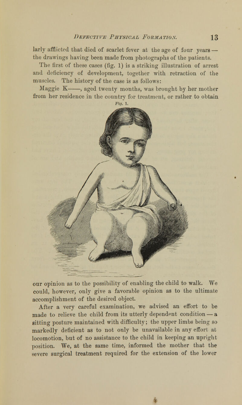 larly afflicted that died of scarlet fever at the age of four years — the drawings having been made from photographs of the patients. The first of these cases (fig. 1) is a striking illustration of arrest and deficiency of development, together with retraction of the muscles. The history of the case is as follows: Maggie K , aged twenty months, was brought by her mother from her residence in the country for treatment, or rather to obtain Wig. 1. our opinion as to the possibility of enabling the child to walk. We could, however, only give a favorable opinion as to the ultimate accomplishment of the desired object. After a very careful examination, we advised an effort to be made to relieve the child from its utterly dependent condition — a sitting posture maintained with difficulty; the upper limbs being so markedly deficient as to not only be unavailable in any effort at locomotion, but of no assistance to the child in keeping an upright position. We, at the same time, informed the mother that the severe surgical treatment required for the extension of the lower