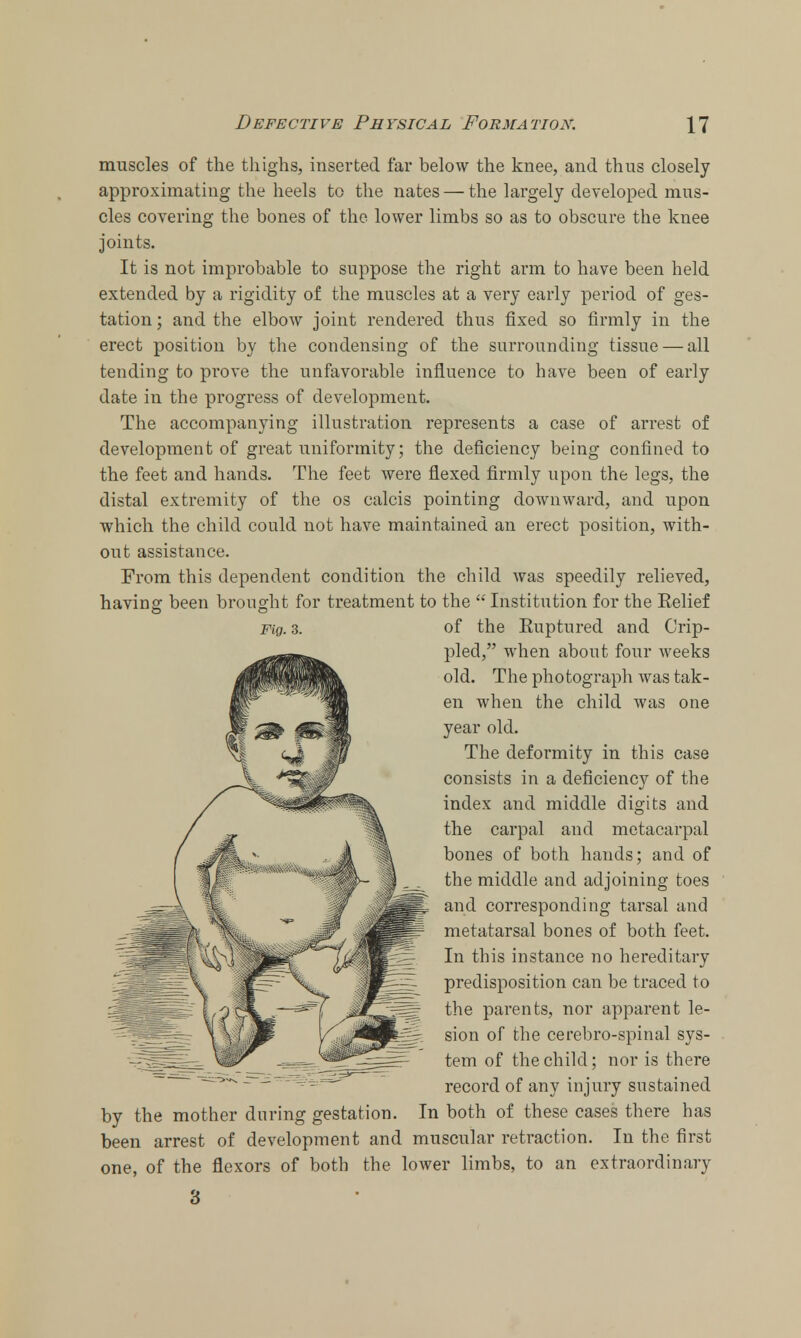 muscles of the thighs, inserted far below the knee, and thus closely approximating the heels to the nates — the largely developed mus- cles covering the bones of the lower limbs so as to obscure the knee joints. It is not improbable to suppose the right arm to have been held extended by a rigidity of the muscles at a very early period of ges- tation ; and the elbow joint rendered thus fixed so firmly in the erect position by the condensing of the surrounding tissue — all tending to prove the unfavorable influence to have been of early date in the progress of development. The accompanying illustration represents a case of arrest of development of great uniformity; the deficiency being confined to the feet and hands. The feet were flexed firmly upon the legs, the distal extremity of the os calcis pointing downward, and upon which the child could not have maintained an erect position, with- out assistance. From this dependent condition the child was speedily relieved, having been brought for treatment to the  Institution for the Relief of the Ruptured and Crip- pled, when about four weeks old. The photograph was tak- en when the child was one year old. The deformity in this case consists in a deficiency of the index and middle digits and the carpal and metacarpal bones of both hands; and of the middle and adjoining toes and corresponding tarsal and metatarsal bones of both feet. In this instance no hereditary predisposition can be traced to the parents, nor apparent le- sion of the cerebro-spinal sys- tem of the child; nor is there record of any injury sustained by the mother during gestation. In both of these cases there has been arrest of development and muscular retraction. In the first one, of the flexors of both the lower limbs, to an extraordinary 3 Fig. 3.