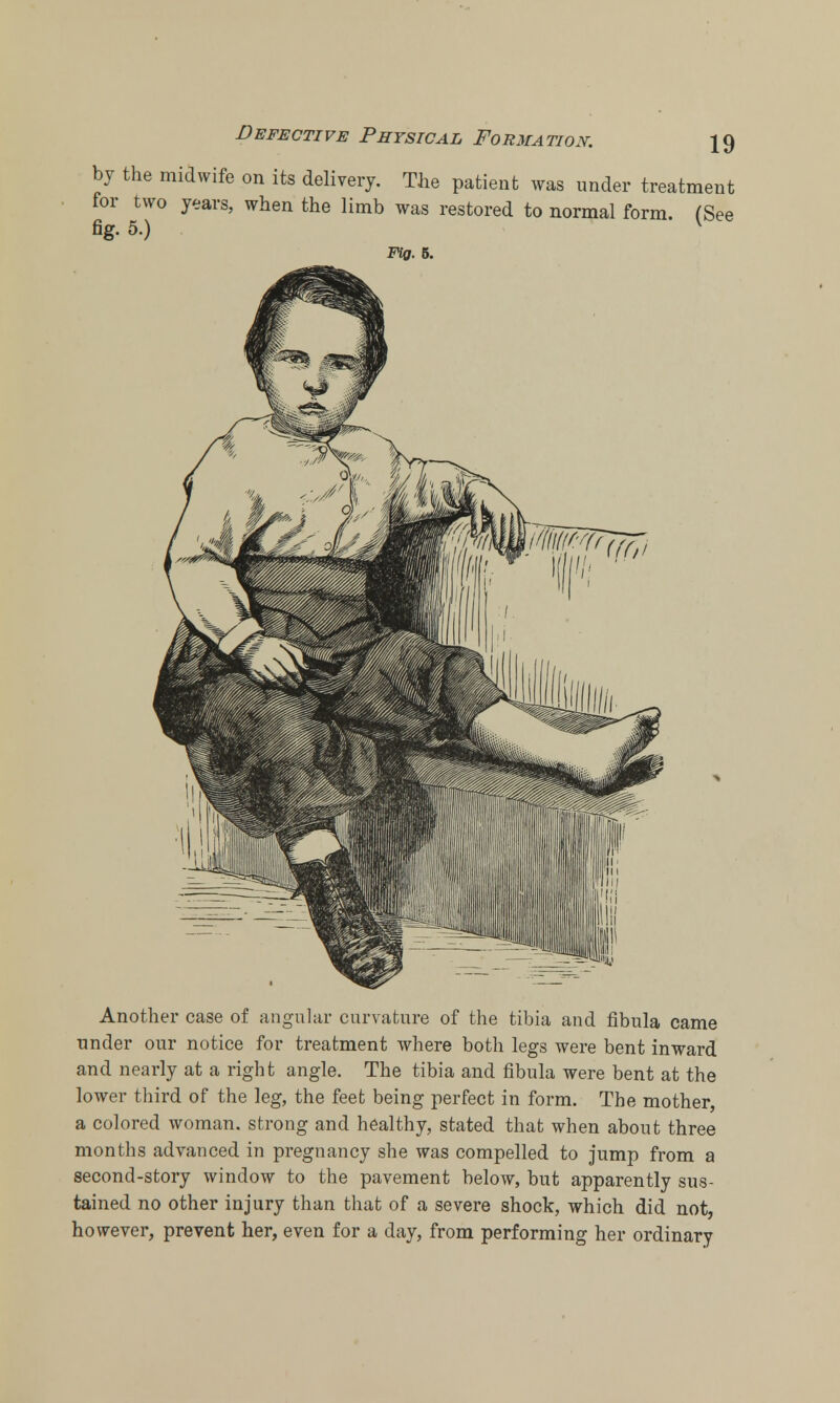 Another case of angular curvature of the tibia and fibula came under our notice for treatment where both legs were bent inward and nearly at a right angle. The tibia and fibula were bent at the lower third of the leg, the feet being perfect in form. The mother, a colored woman, strong and healthy, stated that when about three months advanced in pregnancy she was compelled to jump from a second-story window to the pavement below, but apparently sus- tained no other injury than that of a severe shock, which did not, however, prevent her, even for a day, from performing her ordinary