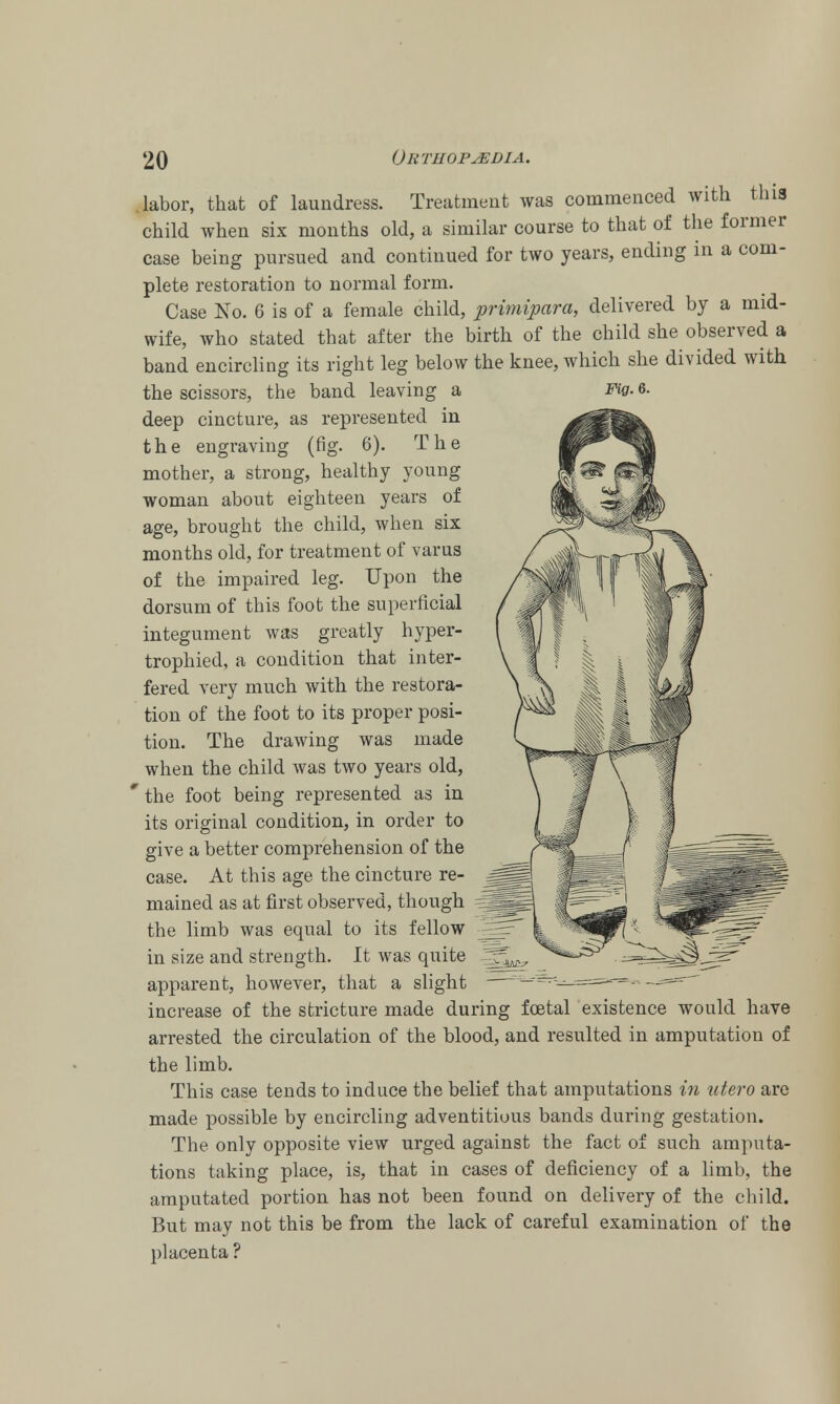 .labor, that of laundress. Treatment was commenced with this child when six months old, a similar course to that of the former case being pursued and continued for two years, ending in a com- plete restoration to normal form. Case No. 6 is of a female child, primipara, delivered by a mid- wife, who stated that after the birth of the child she observed a band encircling its right leg below the knee, which she divided with the scissors, the band leaving a Fig. 6. deep cincture, as represented in the engraving (fig. 6). The mother, a strong, healthy young woman about eighteen years of age, brought the child, when six months old, for treatment of varus of the impaired leg. Upon the dorsum of this foot the superficial integument was greatly hyper- trophied, a condition that inter- fered very much with the restora- tion of the foot to its proper posi- tion. The drawing was made when the child was two years old, * the foot being represented as in its original condition, in order to give a better comprehension of the case. At this age the cincture re- mained as at first observed, though =aj the limb was equal to its fellow in size and strength. It was quite ^ apparent, however, that a slight increase of the stricture made during foetal existence would have arrested the circulation of the blood, and resulted in amputation of the limb. This case tends to induce the belief that amputations in utero are made possible by encircling adventitious bands during gestation. The only opposite view urged against the fact of such amputa- tions taking place, is, that in cases of deficiency of a limb, the amputated portion has not been found on delivery of the child. But may not this be from the lack of careful examination of the placenta ?