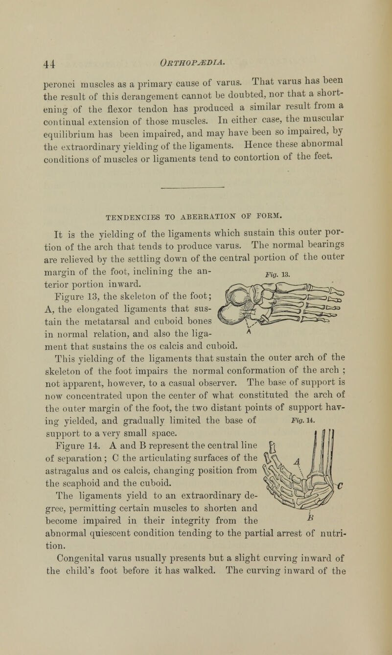 peronci muscles as a primary cause of varus. That varus has been the result of this derangement cannot be doubted, nor that a short- ening of the flexor tendon has produced a similar result from a continual extension of those muscles. In either case, the muscular equilibrium has been impaired, and may have been so impaired, by the extraordinary yielding of the ligaments. Hence these abnormal conditions of muscles or ligaments tend to contortion of the feet. TENDENCIES TO ABERRATION OF FORM. It is the yielding of the ligaments which sustain this outer por- tion of the arch that tends to produce varus. The normal bearings are relieved by the settling down of the central portion of the outer margin of the foot, inclining the an- terior portion inward. Figure 13, the skeleton of the foot; A, the elongated ligaments that sus- tain the metatarsal and cuboid bones in normal relation, and also the liga- ment that sustains the os calcis and cuboid. This yielding of the ligaments that sustain the outer arch of the skeleton of the foot impairs the normal conformation of the arch ; not apparent, however, to a casual observer. The base of support is now concentrated upon the center of what constituted the arch of the outer margin of the foot, the two distant points of support hav- ing yielded, and gradually limited the base of Fig. u. support to a very small space. Figure 14. A and B represent the central line of separation; C the articulating surfaces of the astragalus and os calcis, changing position from the scaphoid and the cuboid. The ligaments yield to an extraordinary de- gree, permitting certain muscles to shorten and become impaired in their integrity from the abnormal quiescent condition tending to the partial arrest of nutri- tion. Congenital varus usually presents but a slight curving inward of the child's foot before it has walked. The curving inward of the