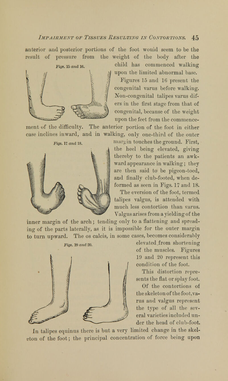 pressure from Figs. 15 and 16. anterior and posterior portions of the foot would seem to be the result of pressure from the weight of the body after the child has commenced walking upon the limited abnormal base. Figures 15 and 16 present the congenital varus before walking. Non-congenital talipes varus dif- ers in the first stage from that of congenital, because of the weight upon the feet from the commence- ment of the difficulty. The anterior portion of the foot in either case inclines inward, and in walking, only one-third of the outer Figs. 17 and 18. margin touches the ground. First, the heel being elevated, giving thereby to the patients an awk- ward appearance in walking; they are then said to be pigeon-toed, and finally club-footed, when de- formed as seen in Figs. 17 and 18. The eversion of the foot, termed talipes valgus, is attended with much less contortion than varus. Valgus arises from a yielding of the inner margin of the arch; tending only to a flattening and spread- ing of the parts laterally, as it is impossible for the outer margin to turn upward. The os calcis, in some cases, becomes considerably Mas. 19and20. elevated.from shortening of the muscles. Figures 19 and 20 represent this condition of the foot. This distortion repre- sents the flat or splay foot. Of the contortions of the skeleton of the foo t,va- rus and valgus represent the type of all the sev- eral varieties included un- der the head of club-foot. In talipes equinus there is but a very limited change in the skel- eton of the foot; the principal concentration of force being upon