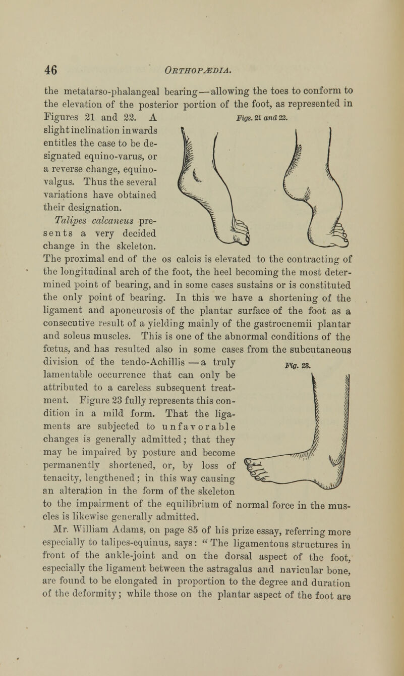 the metatarsophalangeal bearing—allowing the toes to conform to the elevation of the posterior portion of the foot, as represented in Figures 21 and 22. A Figs. 21 and 22. slight inclination inwards entitles the case to be de- signated equino-varus, or a reverse change, equino- valgus. Thus the several variations have obtained their designation. Talipes calcaneus pre- sents a very decided change in the skeleton. The proximal end of the os calcis is elevated to the contracting of the longitudinal arch of the foot, the heel becoming the most deter- mined point of bearing, and in some cases sustains or is constituted the only point of bearing. In this we have a shortening of the ligament and aponeurosis of the plantar surface of the foot as a consecutive result of a yielding mainly of the gastrocnemii plantar and soleus muscles. This is one of the abnormal conditions of the foetus, and has resulted also in some cases from the subcutaneous division of the tendo-Achillis — a truly lamentable occurrence that can only be attributed to a careless subsequent treat- ment. Figure 23 fully represents this con- dition in a mild form. That the liga- ments are subjected to unfavorable changes is generally admitted; that they may be impaired by posture and become permanently shortened, or, by loss of tenacity, lengthened; in this way causing an alteration in the form of the skeleton to the impairment of the equilibrium of normal force in the mus- cles is likewise generally admitted. Mr. William Adams, on page 85 of his prize essay, referring more especially to talipes-equinus, says:  The ligamentous structures in front of the ankle-joint and on the dorsal aspect of the foot, especially the ligament between the astragalus and navicular bone, are found to be elongated in proportion to the degree and duration of the deformity; while those on the plantar aspect of the foot are