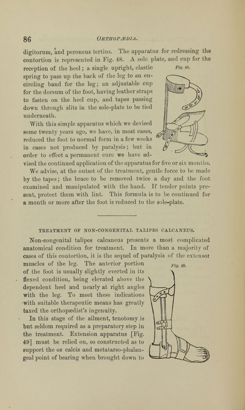 digitorum, and peroneus tertius. The apparatus for redressing the contortion is represented in Fig. 48. A sole plate, and cup for the reception of the heel; a single upright, elastic Fig. 48. spring to pass up the back of the leg to an en- circling band for the leg; an adjustable cup for the dorsum of the foot, having leather straps to fasten on the heel cup, and tapes passing down through slits in the sole-plate to be tied underneath. With this simple apparatus which we devised some twenty years ago, we have, in most cases, reduced the foot to normal form in a few weeks in cases not produced by paralysis; but in order to effect a permanent cure we have ad- vised the continued application of the apparatus for five or six months. We advise, at the outset of the treatment, gentle force to be made by the tapes; the brace to be removed twice a day and the foot examined and manipulated with the hand. If tender points pre- sent, protect them with lint. This formula is to be continued for a month or more after the foot is reduced to the sole-plate. TEEATMENT OF NON-CONGENITAL TALIPES CALCANEUS. Fig. 49. Non-congenital talipes calcaneus presents a most complicated anatomical condition for treatment. In more than a majority of cases of this contortion, it is the sequel of paralysis of the extensor muscles of the leg. The anterior portion of the foot is usually slightly everted in its flexed condition, being elevated above the dependent heel and nearly at right angles with the leg. To meet these indications with suitable therapeutic means has greatly taxed the orthopaedist's ingenuity. In this stage of the ailment, tenotomy is but seldom required as a preparatory step in the treatment. Extension apparatus [Fig. 49] must be relied on, so constructed as to support the os calcis and metatarso-phalan- geal point of bearing when brought down to