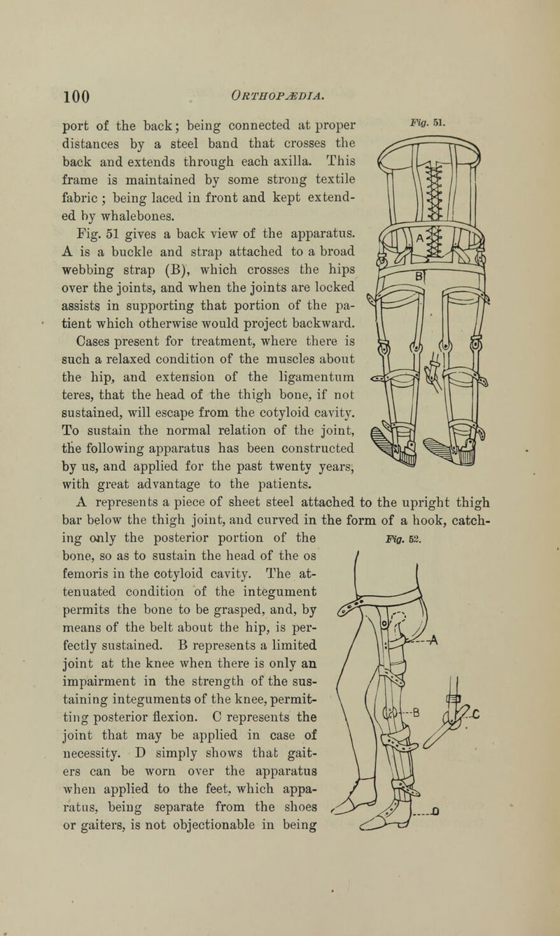 port of the back; being connected at proper 51- distances by a steel band that crosses the back and extends through each axilla. This frame is maintained by some strong textile fabric ; being laced in front and kept extend- ed by whalebones. Fig. 51 gives a back view of the apparatus. A is a buckle and strap attached to a broad webbing strap (B), which crosses the hips over the joints, and when the joints are locked assists in supporting that portion of the pa- tient which otherwise would project backward. Cases present for treatment, where there is such a relaxed condition of the muscles about the hip, and extension of the ligamentum teres, that the head of the thigh bone, if not sustained, will escape from the cotyloid cavity. To sustain the normal relation of the joint, the following apparatus has been constructed by us, and applied for the past twenty years, with great advantage to the patients. A represents a piece of sheet steel attached to the upright thig bar below the thigh joint, and curved in the form of a hook, catch ing only the posterior portion of the bone, so as to sustain the head of the os femoris in the cotyloid cavity. The at- tenuated condition of the integument permits the bone to be grasped, and, by means of the belt about the hip, is per- fectly sustained. B represents a limited joint at the knee when there is only an impairment in the strength of the sus- taining integuments of the knee, permit- ting posterior flexion. C represents the joint that may be applied in case of necessity. D simply shows that gait- ers can be worn over the apparatus when applied to the feet, which appa- ratus, being separate from the shoes or gaiters, is not objectionable in being Fig. 52.