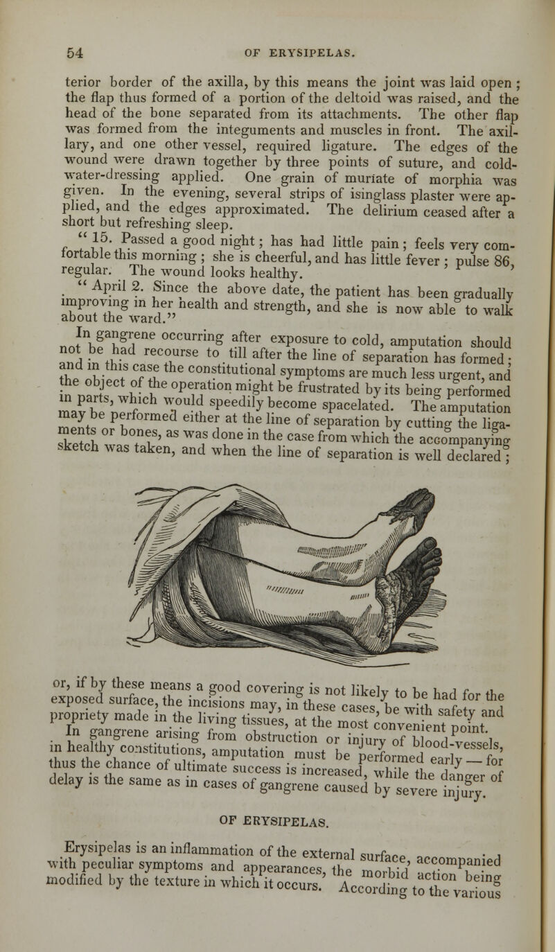 terior border of the axilla, by this means the joint was laid open ; the flap thus formed of a portion of the deltoid was raised, and the head of the bone separated from its attachments. The other flap was formed from the integuments and muscles in front. The axil- lary, and one other vessel, required ligature. The edges of the wound were drawn together by three points of suture, and cold- water-dressing applied. One grain of muriate of morphia was g\ven- In the evening, several strips of isinglass plaster were ap- plied, and the edges approximated. The delirium ceased after a short but refreshing sleep.  J5* Passed a good night; has had little pain ; feels very com- fortable this morning ; she is cheerful, and has little fever : pulse 86, regular. The wound looks healthy.  April 2. Since the above date, the patient has been gradually aZnKrd!1'11 * ^^ * *«  n°W &ble t0 ™* nnfnbf Iff™ °CCUrri?S #* exP°s»re to cold, amputation should and Itb* reTrSe t0- hl aft6r the Hne of reparation has formed ; Z 1^ Tl e Constltutlonal symptoms are much less urgent, and n nf ?■ ?C °^fhon miSht ^ frustrated by its being performed nafb 'Jrfn Tlt P^ybecome spacelated. ^amputation mpnt^ Jl^ Glthei 3t the lme °f nation by cutting the liga- Setch w b?lS' ^ Waf dfe m,the CaSe fr0m which *he accompanying sketch was taken, and when the line of separation is well declared! or, if by these means a good covering is not likely to be had for Ap exposed surface, the incisions may, kthese cases/be with safety and propriety made in the living tissues, at the most convlnient pofnt  I fTgrene.anSmg fr°m Auction or injunof bCd-veTJels in healthy constitutions, amputation must be oerformpr ? J ' thus the chance of ultimate'success is infreased^ fhKfc/S delay is the same as in cases of gangrene caused by severe in^ry. OF ERYSIPELAS. Erysipelas is an inflammation of the exterml c,„x„> . , with peculiar symptoms and appearances the morTid ^T^ modified by the texture in whicfo occurs.' 'According to t^vaTul