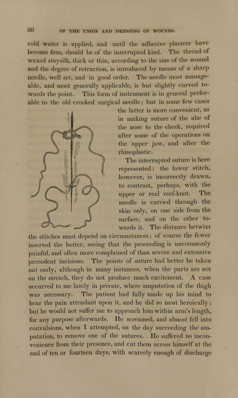 cold water is applied, and until the adhesive plasters have become firm, should be of the interrupted kind. The thread of waxed staysilk, thick or thin, according to the size of the wound and the degree of retraction, is introduced by means of a sharp needle, well set, and in good order. The needle most manage- able, and most generally applicable, is but slightly curved to- wards the point. This form of instrument is in general prefer- able to the old crooked surgical needle; but in some few cases the latter is more convenient, as in making suture of the alas of the nose to the cheek, required after some of the operations on the upper jaw, and after the rhinoplasties The interrupted suture is here represented; the lower stitch, however, is incorrectly drawn, to contrast, perhaps, with the upper or real reef-knot. The needle is carried through the skin only, on one side from the surface, and on the other to- wards it. The distance betwixt the stitches must depend on circumstances; of course tlje fewer inserted the better, seeing that the proceeding is uncommonly painful, and often more complained of than severe and extensive precedent incisions. The points of suture had better be taken out early, although in many instances, when the parts are not on the stretch, they do not produce much excitement. A case occurred to me lately in private, where amputation of the thigh was necessary. The patient had fully made up his mind to bear the pain attendant upon it, and he did so most heroically; but he would not suffer me to approach him within arm's length, for any purpose afterwards. He screamed, and almost fell into convulsions, when I attempted, on the day succeeding the am- putation, to remove one of the sutures. He suffered no incon- venience from their presence, and cut them across himself at the end of ten or fourteen days, with scarcely enough of discharge