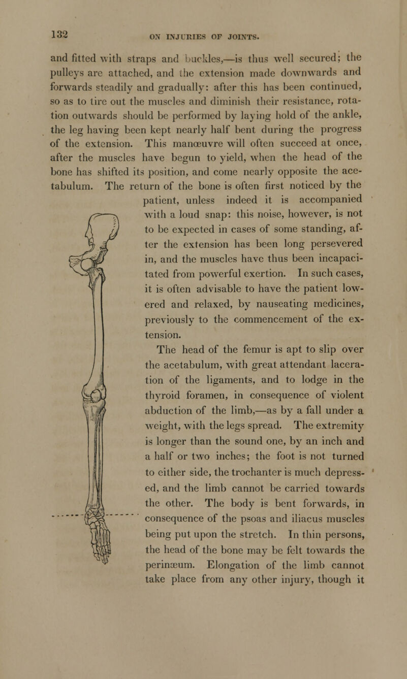 and fitted with straps and buckles,—is thus well secured; the pulleys are attached, and the extension made downwards and forwards steadily and gradually: after this has been continued, so as to tire out the muscles and diminish their resistance, rota- tion outwards should be performed by laying hold of the ankle, the leg having been kept nearly half bent during the progress of the extension. This manoeuvre will often succeed at once, after the muscles have begun to yield, when the head of the bone has shifted its position, and come nearly opposite the ace- tabulum. The return of the bone is often first noticed by the patient, unless indeed it is accompanied with a loud snap: this noise, however, is not to be expected in cases of some standing, af- ter the extension has been long persevered in, and the muscles have thus been incapaci- tated from powerful exertion. In such cases, it is often advisable to have the patient low- ered and relaxed, by nauseating medicines, previously to the commencement of the ex- tension. The head of the femur is apt to slip over the acetabulum, with great attendant lacera- tion of the ligaments, and to lodge in the thyroid foramen, in consequence of violent abduction of the limb,—as by a fall under a weight, with the legs spread. The extremity is longer than the sound one, by an inch and a half or two inches; the foot is not turned to either side, the trochanter is much depress- ed, and the limb cannot be carried towards the other. The body is bent forwards, in consequence of the psoas and iliacus muscles being put upon the stretch. In thin persons, the head of the bone may be felt towards the perinoeum. Elongation of the limb cannot take place from any other injury, though it