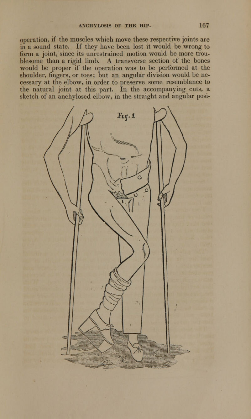 operation, if the muscles which move these respective joints are in a sound state. If they have been lost it would be wrong to form a joint, since its unrestrained motion would be more trou- blesome than a rigid limb. A transverse section of the bones would be proper if the operation was to be performed at the shoulder, fingers, or toes; but an angular division would be ne- cessary at the elbow, in order to preserve some resemblance to the natural joint at this part. In the accompanying cuts, a sketch of an anchylosed elbow, in the straight and angular posi-