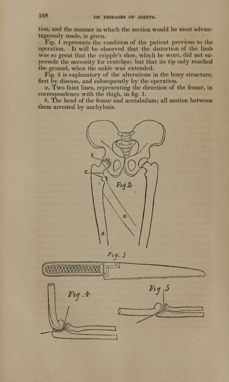 ON DISEASES OF JOINTS. tion, and the manner in which the section would be most advan- tageously made, is given. Fig. 1 represents the condition of the patient previous to the operation. It will be observed that the distortion of the limb was so great that the cripple's shoe, which he wore, did not su- persede the necessity for crutches; but that its tip only reached the ground, when the ankle was extended. Fig. 2 is explanatory of the alterations in the bony structure, first by disease, and subsequently by the operation. a, Two faint lines, representing the direction of the femur, in correspondence with the thigh, in fig. 1. b, The head of the femur and acetabulum; all motion between them arrested by anchylosis.