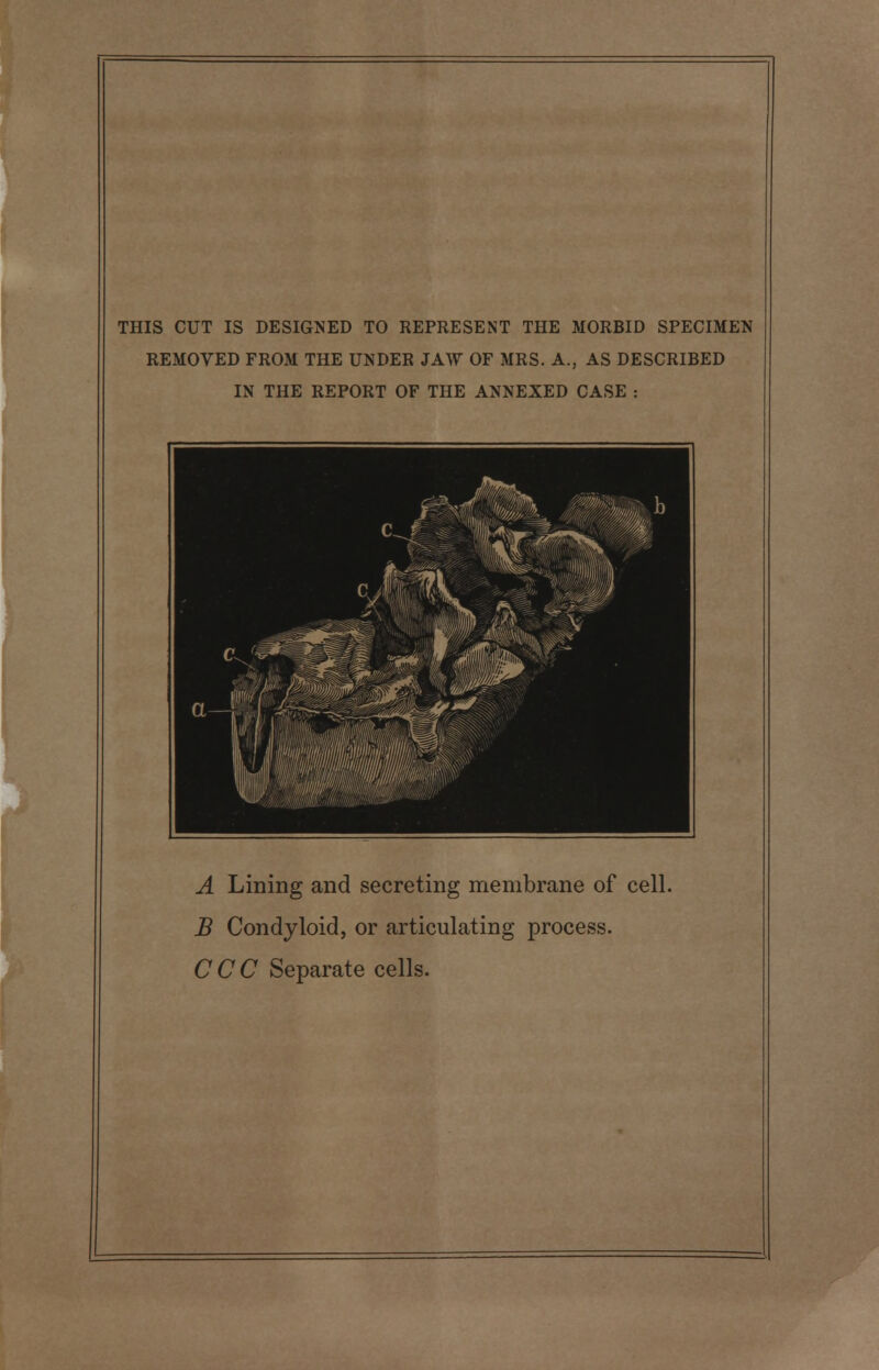 THIS CUT IS DESIGNED TO REPRESENT THE MORBID SPECIMEN REMOVED FROM THE UNDER JAW OF MRS. A., AS DESCRIBED IN THE REPORT OF THE ANNEXED CASE : A Lining and secreting membrane of cell. B Condyloid, or articulating process. CCC Separate cells.