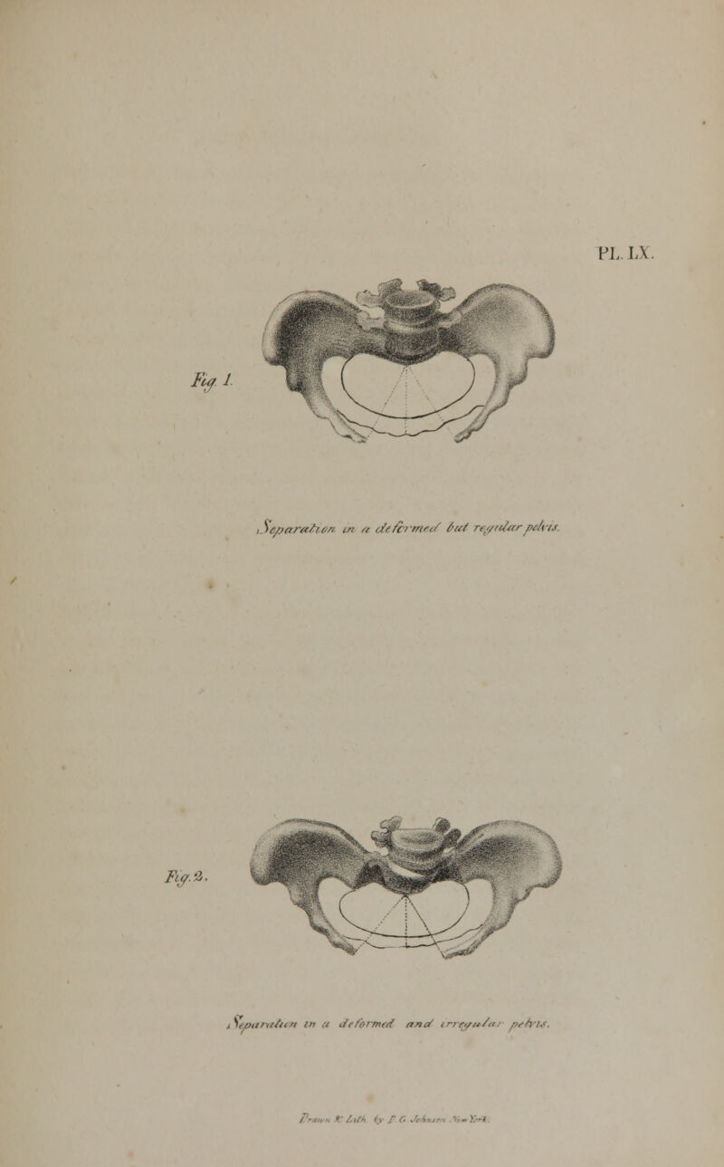 PL. IX Fifl tSepara/u.n in u defin'tncd $ut regularpelvis. Fuyi. iiept$rat*en in a deformed ana' irrapu-Ja-/ peiviA ■