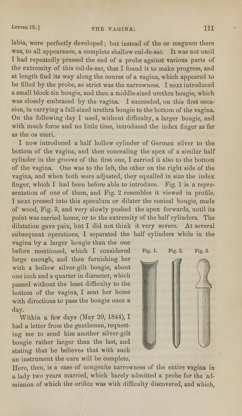 labia, were perfectly developed; but instead of the os magnum there was, to all appearance, a complete shallow cul-de-sac. It was not until I had repeatedly pressed the end of a probe against various parts of the extremity of this cul-de-sac, that I found it to make progress, and at length find its way along the course of a vagina, which appeared to be filled by the probe, so strict was the narrowness. I next introduced a small block-tin bougie, and then a middle-sized urethra bougie, which was closely embraced by the vagina. I succeeded, on this first occa- sion, in carrying a full-sized urethra bougie to the bottom of the vagina. On the following day I used, without difficulty, a larger bougie, and with much force and no little time, introduced the index finger as far as the os uteri. I now introduced a half hollow cylinder of German silver to the bottom of the vagina, and then concealing the apex of a similar half cylinder in the groove of the first one, I carried it also to the bottom of the vagina. One was to the left, the other on the right side of the vagina, and when both were adjusted, they equalled in size the index finger, which I had been before able to introduce. Fig. 1 is a repre- sentation of one of them, and Fig. 2 resembles it viewed in profile. I next pressed into this speculum or dilater the conical bougie, made of wood, Fig. 3, and very slowly pushed the apex forwards, until its point was carried home, or to the extremity of the half cylinders. The dilatation gave pain, but I did not think it very severe. At several subsequent operations, I separated the half cylinders while in the vagina by a larger bougie than the one before mentioned, which I considered Fig. 1. Fig. 2. large enough, and then furnishing her with a hollow silver-gilt bougie, about one inch and a quarter in diameter, which passed without the least difficulty to the bottom of the vagina, I sent her home with directions to pass the bougie once a day. Within a few days (May 20, 1844), I had a letter from the gentleman, request- ing me to send him another silver-gilt bougie rather larger than the last, and stating that he believes that with such an instrument the cure will be complete. Here, then, is a case of congenite narrowness of the entire vagina in a lady two years married, which barely admitted a probe for the ad- mission of which the orifice was with difficulty discovered, and which, Fig. 3.