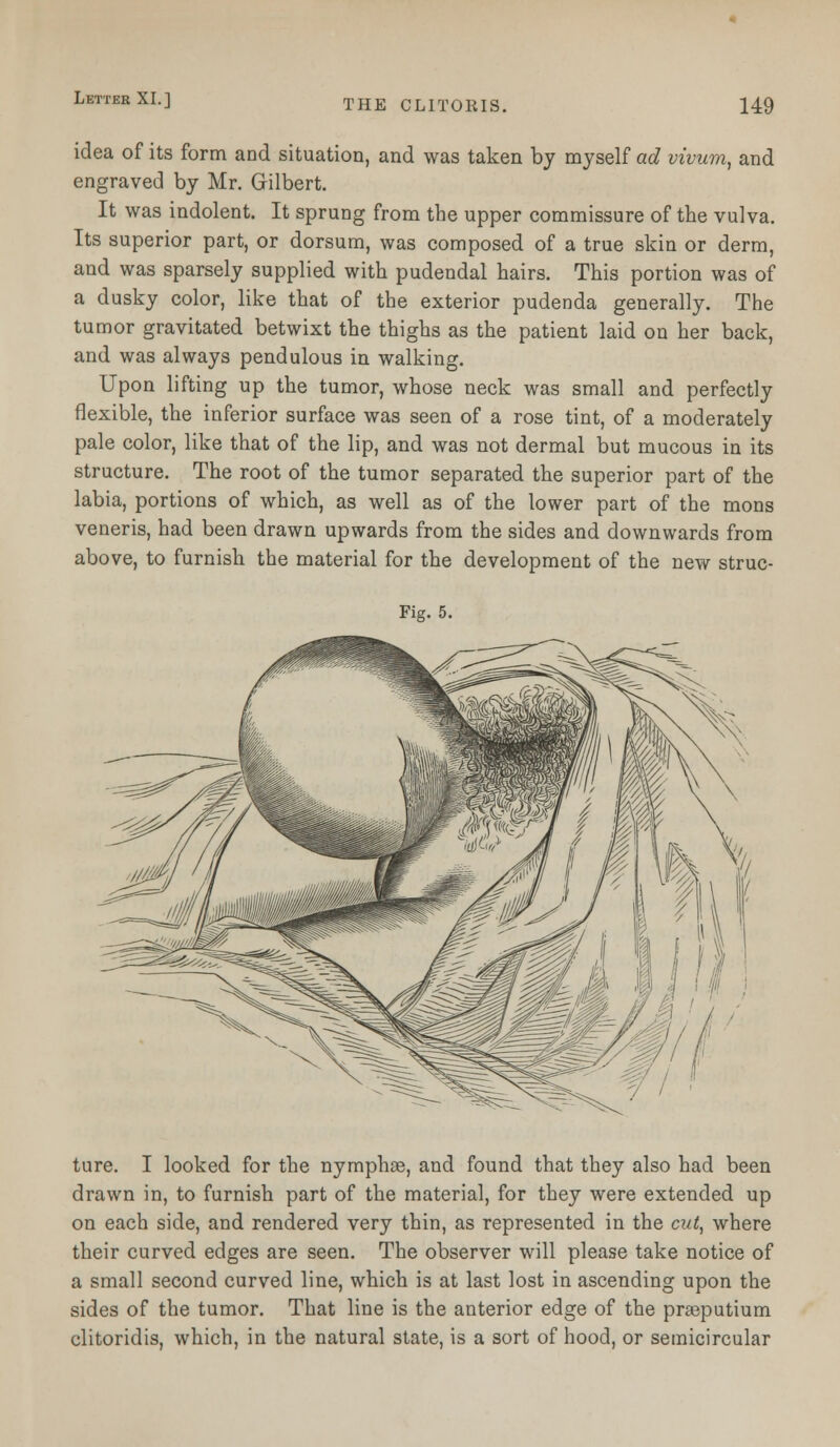 Letter XL] idea of its form and situation, and was taken by myself ad vivum, and engraved by Mr. Gilbert. It was indolent. It sprung from the upper commissure of the vulva. Its superior part, or dorsum, was composed of a true skin or derm, and was sparsely supplied with pudendal hairs. This portion was of a dusky color, like that of the exterior pudenda generally. The tumor gravitated betwixt the thighs as the patient laid on her back, and was always pendulous in walking. Upon lifting up the tumor, whose neck was small and perfectly flexible, the inferior surface was seen of a rose tint, of a moderately pale color, like that of the lip, and was not dermal but mucous in its structure. The root of the tumor separated the superior part of the labia, portions of which, as well as of the lower part of the mons veneris, had been drawn upwards from the sides and downwards from above, to furnish the material for the development of the new struc- Fig. 5. ture. I looked for the nymphae, and found that they also had been drawn in, to furnish part of the material, for they were extended up on each side, and rendered very thin, as represented in the cut, where their curved edges are seen. The observer will please take notice of a small second curved line, which is at last lost in ascending upon the sides of the tumor. That line is the anterior edge of the praeputium clitoridis, which, in the natural state, is a sort of hood, or semicircular