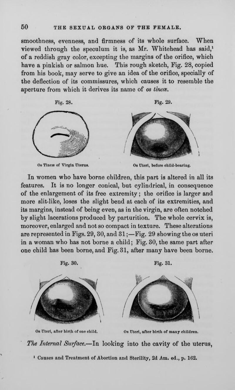 smoothness, evenness, and firmness of its whole surface. When viewed through the speculum it is, as Mr. Whitehead has said,1 of a reddish gray color, excepting the margins of the orifice, which have a pinkish or salmon hue. This rough sketch, Fig. 28, copied from his book, may serve to give an idea of the orifice, specially of the deflection of its commissures, which causes it to resemble the aperture from which it derives its name of os tincce. Fig. 28. Fig. 29. Os Tincse of Virgin Uterus. Os Uteri, before child-bearing. In women who have borne children, this part is altered in all its features. It is no longer conical, but cylindrical, in consequence of the enlargement of its free extremity; the orifice is larger and more slit-like, loses the slight bend at each of its extremities, and its margins, instead of being even, as in the virgin, are often notched by slight lacerations produced by parturition. The whole cervix is, moreover, enlarged and not so compact in texture. These alterations are represented in Figs. 29, 30, and 31;—Fig. 29 showing the os uteri in a woman who has not borne a child; Fig. 30, the same part after one child has been borne, and Fig. 31, after many have been borne. Fig. 30. Fig. 31. Os Utori, after birth of one child. Os Uteri, after birth of many children. The Internal Surface.—In looking into the cavity of the uterus, 1 Causes and Treatment of Abortion and Sterility, 2d Am. ed., p. 162.