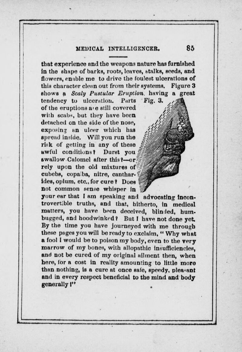 that experience and the weapons nature has furnished in the shape of barks, roots, leaves, b talks, seeds, and flowers, en-ible me to drive the foulest ulcerations of this character clean out from their systems. Figure 3 shows a Scaly Pustular Eruption, having a great tendency to ulceration. Parts Fig. 3. of the eruptions a>e still covered wilh scab*, but they have been detached on the side of the nose, exposing an ulcer which has spread inside. Will you run the risk of getting in any of these • awful conditions? Durst you^ 6wallow Calomel after this?—or^s rely upon the old mixtures of! cubebs, copaiba, nitre, canthar-s ides, opium, etc., for cure ? Does not common sense whisper in your ear that I am speaking and advocating Incon- trovertible truths, and that, hitherto, in medical matters, you have been deceived, blinded, hum- bugged, and hoodwinkrd? But I have not done yet. By the time you have journeyed with me through these pages you will be ready to exclaim,  Why what a fool I would be to poison my body, even to the very marrow of my bones, with allopathic insufficiencies, and not be cured of my original ailment then, when here, for a cost in reality amounting to little more than nothing, is a cure at once safe, speedy, plea-ant and in every respect beneficial to the mind and body generally I