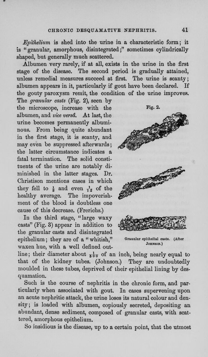 Fig. 2. Epithelium is shed into the urine in a characteristic form; it is granular, amorphous, disintegrated; sometimes cylindrically shaped, but generally much scattered. Albumen very rarely, if at all, exists in the urine in the first stage of the disease. The second period is gradually attained, unless remedial measures succeed at first. The urine is scanty; albumen appears in it, particularly if gout have been declared. If the gouty paroxysm remit, the condition of the urine improves. The granular casts (Fig. 2), seen by the microscope, increase with the albumen, and vice versa. At last, the urine becomes permanently albumi- nous. From being quite abundant in the first stage, it is scanty, and may even be suppressed afterwards; the latter circumstance indicates a fatal termination. The solid consti- tuents of the urine are notably di- minished in the latter stages. Dr. Christison mentions cases in which they fell to £ and even ^2 of the healthy average. The impoverish- ment of the blood is doubtless one cause of this decrease. (Frerichs.) In the third stage, large waxy casts (Fig. 3) appear in addition to the granular casts and disintegrated epithelium; they are of a  whitish, waxen hue, with a well defined out- line ; their diameter about v^v of an inch, being nearly equal to that of the kidney tubes. (Johnson.) They are undoubtedly moulded in these tubes, deprived of their epithelial lining by des- quamation. Such is the course of nephritis in the chronic form, and par- ticularly when associated with gout. In cases supervening upon an acute nephritic attack, the urine loses its natural colour and den- sity; is loaded with albumen, copiously secreted, depositing an abundant, dense sediment, composed of granular casts, with scat- tered, amorphous epithelium. So insidious is the disease, up to a certain point, that the utmost Granular epithelial casts. (After Johnson.)