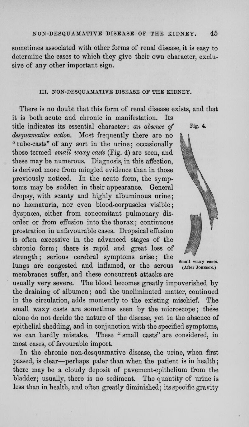 sometimes associated with other forms of renal disease, it is easy to determine the cases to which they give their own character, exclu- sive of any other important sign. III. NON-DESQUAMATIVE DISEASE OF THE KIDNEY. There is no doubt that this form of renal disease exists, and that it is both acute and chronic in manifestation. Its title indicates its essential character: an absence of Fig. 4. desquamative action. Most frequently there are no  tube-casts of any sort in the urine; occasionally those termed small waxy casts (Fig. 4) are seen, and these may be numerous. Diagnosis, in this affection, is derived more from mingled evidence than in those lltfrV previously noticed. In the acute form, the symp- llk\ toms may be sudden in their appearance. General ik\ dropsy, with scanty and highly albuminous urine; llflk no hematuria, nor even blood-corpuscles visible; lpt\ dyspnoea, either from concomitant pulmonary dis- ,|1m,| «§ order or from effusion into the thorax; continuous ll 1 1' ■ • 111 I' prostration in unfavourable cases. Dropsical effusion Ml is often excessive in the advanced stages of the JfJIi chronic form; there is rapid and great loss of Mm strength; serious cerebral symptoms arise; the . i i ' n 1 i Small waxy casts. lungs are congested and inflamed, or the serous (After johkbok.) membranes suffer, and these concurrent attacks are usually very severe. The blood becomes greatly impoverished by the draining of albumen; and the uneliminated matter, continued in the circulation, adds momently to the existing mischief. The small waxy casts are sometimes seen by the microscope; these alone do not decide the nature of the disease, yet in the absence of epithelial shedding, and in conjunction with the specified symptoms, we can hardly mistake. These  small casts are considered, in most cases, of favourable import. In the chronic non-desquamative disease, the urine, when first passed, is clear—perhaps paler than when the patient is in health; there may be a cloudy deposit of pavement-epithelium from the bladder; usually, there is no sediment. The quantity of urine is less than in health, and often greatly diminished; its specific gravity