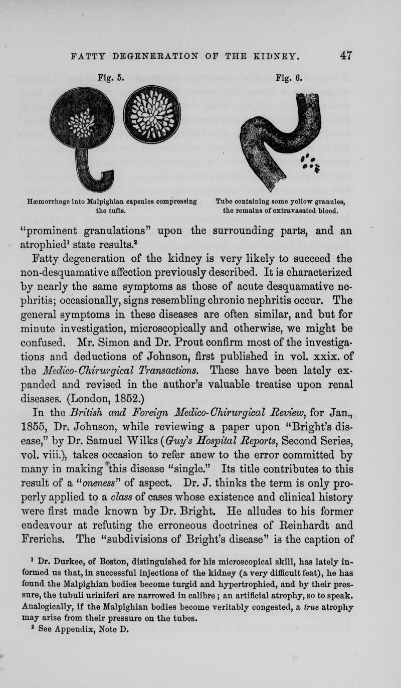 Fig. 5. Fig. 6. Hemorrhage into Malpighian capsules compressing Tube containing some yellow granules, the tufts. the remains of extravasated blood. prominent granulations upon the surrounding parts, and an atrophied1 state results.2 Fatty degeneration of the kidney is very likely to succeed the non-desquamative affection previously described. It is characterized by nearly the same symptoms as those of acute desquamative ne- phritis; occasionally, signs resembling chronic nephritis occur. The general symptoms in these diseases are often similar, and but for minute investigation, microscopically and otherwise, we might be confused. Mr. Simon and Dr. Prout confirm most of the investiga- tions and deductions of Johnson, first published in vol. xxix. of the Medico-Ghirurgical Transactions. These have been lately ex- panded and revised in the author's valuable treatise upon renal diseases. (London, 1852.) In the British and Foreign Medico-Ghirurgical Review, for Jan., 1855, Dr. Johnson, while reviewing a paper upon Bright's dis- ease, by Dr. Samuel Wilks (Guy's Hospital Reports, Second Series, vol. viii.), takes occasion to refer anew to the error committed by many in making this disease single. Its title contributes to this result of a oneness of aspect. Dr. J. thinks the term is only pro- perly applied to a class of cases whose existence and clinical history were first made known by Dr. Bright. He alludes to his former endeavour at refuting the erroneous doctrines of Eeinhardt and Frerichs. The subdivisions of Bright's disease is the caption of 1 Dr. Durkee, of Boston, distinguished for his microscopical skill, has lately in- formed us that, in successful injections of the kidney (a very difficult feat), he has found the Malpighian bodies become turgid and hypertrophied, and by their pres- sure, the tubuli uriniferi are narrowed in calibre ; an artificial atrophy, so to speak. Analogically, if the Malpighian bodies become veritably congested, a true atrophy may arise from their pressure on the tubes. 2 See Appendix, Note D.