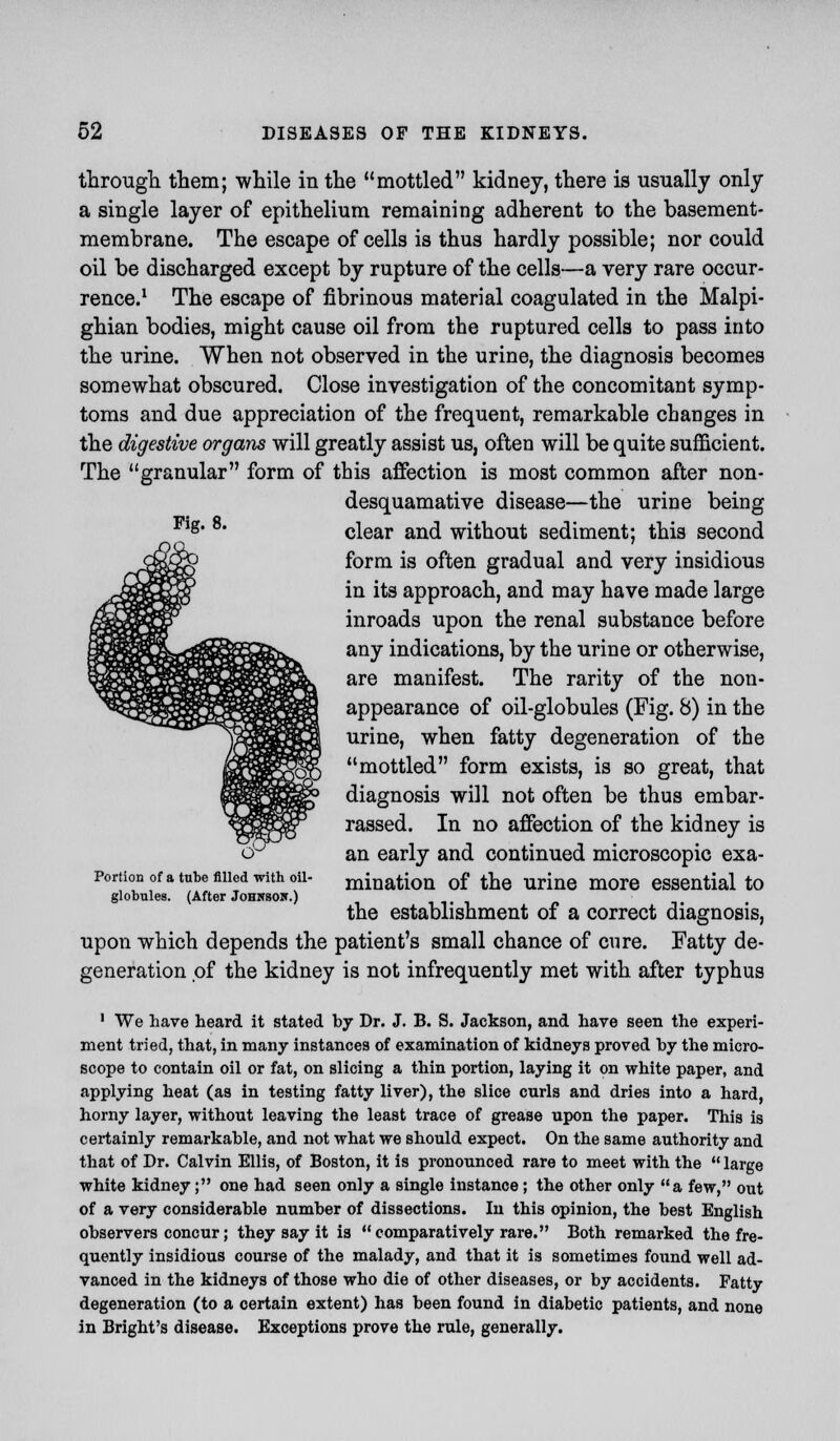 through them; while in the mottled kidney, there is usually only a single layer of epithelium remaining adherent to the basement- membrane. The escape of cells is thus hardly possible; nor could oil be discharged except by rupture of the cells—a very rare occur- rence.1 The escape of fibrinous material coagulated in the Malpi- ghian bodies, might cause oil from the ruptured cells to pass into the urine. When not observed in the urine, the diagnosis becomes somewhat obscured. Close investigation of the concomitant symp- toms and due appreciation of the frequent, remarkable changes in the digestive organs will greatly assist us, often will be quite sufficient. The granular form of this affection is most common after non- desquamative disease—the urine being ^lg clear and without sediment; this second form is often gradual and very insidious in its approach, and may have made large inroads upon the renal substance before any indications, by the urine or otherwise, are manifest. The rarity of the non- appearance of oil-globules (Fig. 8) in the urine, when fatty degeneration of the mottled form exists, is so great, that diagnosis will not often be thus embar- rassed. In no affection of the kidney is cK an early and continued microscopic exa- Portion of a tube filled with oil- minati0n of the urine more essential to globules. (After Johnson.) the establishment of a correct diagnosis, upon which depends the patient's small chance of cure. Fatty de- generation of the kidney is not infrequently met with after typhus 1 We have heard it stated by Dr. J. B. S. Jackson, and have seen the experi- ment tried, that, in many instances of examination of kidneys proved by the micro- scope to contain oil or fat, on slicing a thin portion, laying it on white paper, and applying heat (as in testing fatty liver), the slice curls and dries into a hard, horny layer, without leaving the least trace of grease upon the paper. This is certainly remarkable, and not what we should expect. On the same authority and that of Dr. Calvin Ellis, of Boston, it is pronounced rare to meet with the  large white kidney; one had seen only a single instance; the other only a few, out of a very considerable number of dissections. In this opinion, the best English observers concur; they say it is  comparatively rare. Both remarked the fre- quently insidious course of the malady, and that it is sometimes found well ad- vanced in the kidneys of those who die of other diseases, or by accidents. Fatty degeneration (to a certain extent) has been found in diabetic patients, and none in Bright's disease. Exceptions prove the rule, generally.