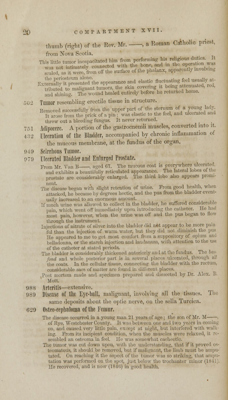 thumb (right) of the Rev. Mr. , a Roman Catholic priest, from Nova Scotia. This little tumor incapacitated him from performing his religious duties. It w-rfnot tima ell connected with the bone, and in the opera Sodas it? ™4 from off the surface of the phalanx, apparently Uivolvmg *£S$£Z££S*» appearance^ elastic *»£££ tributed to malignant tumors, the skin covering it being attenuated, reu, and shining. The wound healed entirely before he returned home. 502 Tumor resembling erectile tissue in structure. Removed successfully from the upper part of the sternum of a young lady. ft arose from the prick of a pin ; was elastic to the feel, and ulcerated and threw out a bleeding fungus. It never returned. 751 Adipocerc. A portion of the gastrocnemii muscles, converted into it. 432 Ulceration of the Bladder, accompanied by chronic inflammation of the mucous membrane, at the fundus of the organ. 949 Scirrhous Tumor. 979 Ulcerated Bladder and Enlarged Prostate. From Mr Van B . aged 67. The mucous coat is everywhere ulcerated and exhibits a beautifully reticulated appearance. The lateral lol.es o1 thi prostate are considerably enlarged. The third lobe also appears pronn- The disease began with slight retention of urine. From good health, when attacked, he became by degrees hectic, and the pus from the bladder event- ually increased to an enormous amount. If much urine was allowed to collect in the bladder, he suffered considerable pain, which went off immediately upon introducing the catheter. He most pain, however, when the urine was off and the pus began to flow through the instrument. Injections of nitrate of silver into the bladder did net appear to, be more pain fulthan the injection of warm water, but they did not diminish th He appeared to me to get most comfort from a suppository of opium and beUadonna, or the starch injection and laudanum, with attention to tiv of the catheter at stated periods. The bladder is considerably thickened anterji irly and at the fundus. The bas- fond and whole posterior part is in several places ufvrated, throu the coats. In the cellular tissue, ooanecting the bladder with the rectum, considerable sacs of matter are found in different pi* Fost mortem made and specimen | ad dissected by Dr. Alex. B. Mott. 988 Arteritis—extensive. 989 Disease Of the Ej'C-ball, malignant, involving all the tissues. The same deposits about the optic nerve, ou the sella Turcica. 629 Osteo-cephaloma of the Femur. The disease occurred in a young man 21 years of age; the son of Mr. M . of Rye, Westchester County. It was between one and two years in coming on, and caused very little pain, except at night, but interfered with ing. From its incipient condition, when the muscles were relaxed, it n - sembled an osteoma in feel. He was somewhat cachectic. The tumor was cut down upon, with the understanding, that if it proved OS- teomatous, it should be removed, bu1 if malignant, the limb must be ampu- tated. On reaching it the aspect of the tumor was so striking, thai tation was performed on the spot, just below the trochanter minor (18 11 , He recovered, and is now (18-40) in good health.