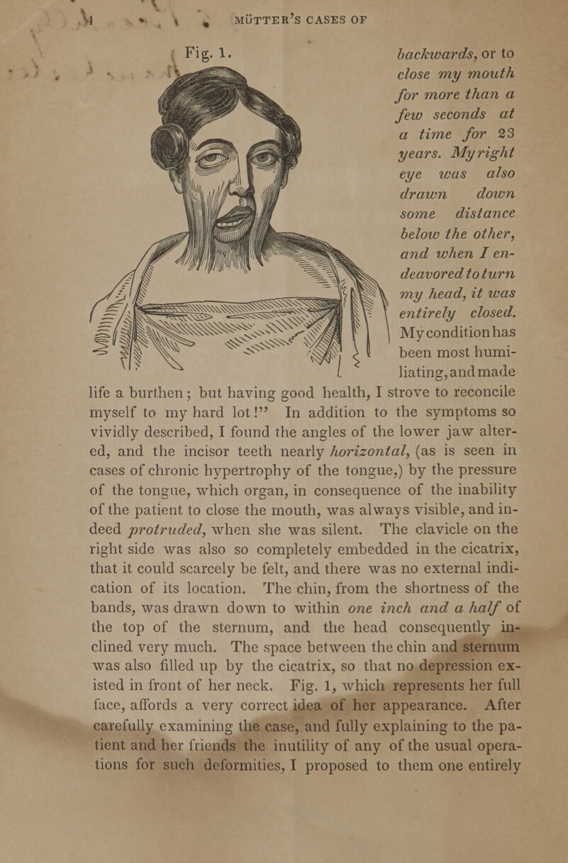 Fig. 1. backwards, or to close my mouth for more than a few seconds at a time for 23 years. My right eye was also drawn down some distance below the other, and when I en- deavored to turn my head, it was entirely closed. My condition has been most humi- liating, and made life a burthen; but having good health, I strove to reconcile myself to my hard lot! In addition to the symptoms so vividly described, I found the angles of the lower jaw alter- ed, and the incisor teeth nearly horizontal, (as is seen in cases of chronic hypertrophy of the tongue,) by the pressure of the tongue, which organ, in consequence of the inability of the patient to close the mouth, was always visible, and in- deed protruded, when she was silent. The clavicle on the right side was also so completely embedded in the cicatrix, that it could scarcely be felt, and there was no external indi- cation of its location. The chin, from the shortness of the bands, was drawn down to within one inch and a half of the top of the sternum, and the head consequently in- clined very much. The space between the chin and sternum was also filled up by the cicatrix, so that no depression ex- isted in front of her neck. Fig. 1, which represents her full face, affords a very correct idea of her appearance. After carefully examining the case, and fully explaining to the pa- tient and her friends the inutility of any of the usual opera-