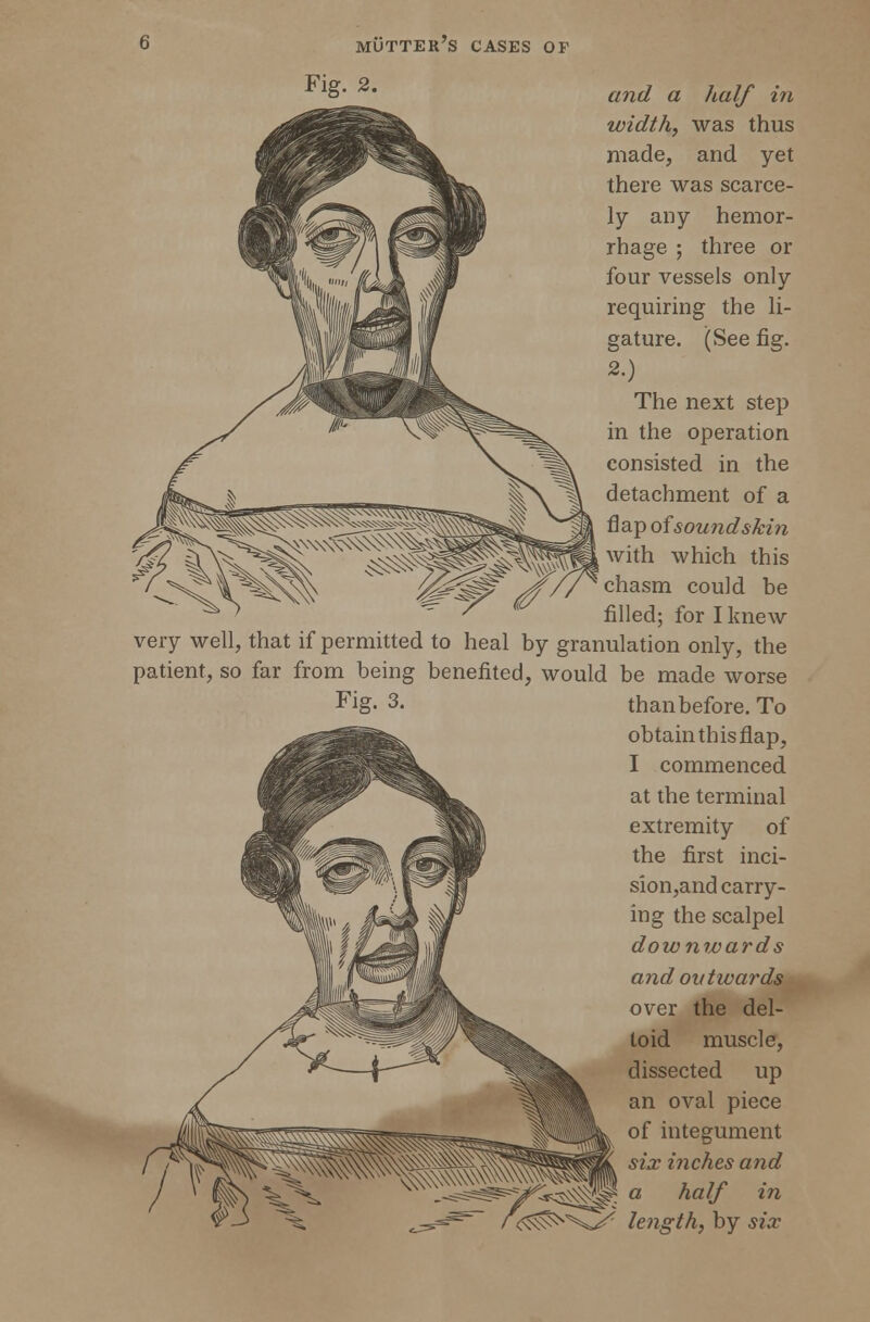 and a half in width, was thus made, and yet there was scarce- ly any hemor- rhage ; three or four vessels only requiring the li- gature. (See fig. 2.) The next step in the operation consisted in the detachment of a flap of sound skin with which this chasm could be filled; for I knew very well, that if permitted to heal by granulation only, the patient, so far from being benefited, would be made worse obtain this flap, I commenced at the terminal extremity of the first inci- sion,and carry- ing the scalpel downwards and outwards over the del- toid muscle, dissected up an oval piece of integument six inches and a half in length, by six