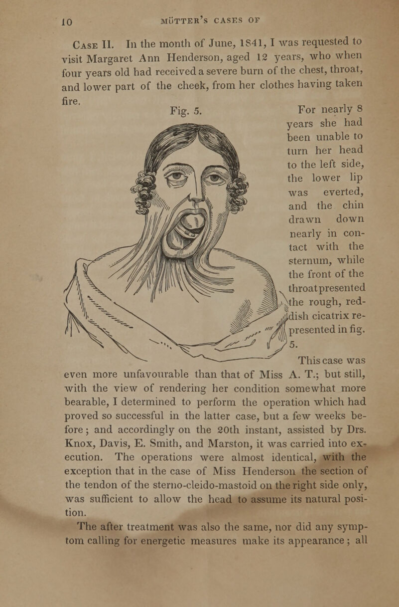 Case II. In the month of June, 1S41, I was requested to visit Margaret Ann Henderson, aged 12 years, who when four years old had received a severe bam of the chest, throat, and lower part of the cheek, from her clothes having taken For nearly 8 years she had been unable to turn her head to the left side, the lower lip was everted, and the chin drawn down nearly in con- tact with the sternum, while the front of the throatpresented ,,1-^the rough, red- dish cicatrix re- | presented in fig. This case was even more unfavourable than that of Miss A. T.; but still, with the view of rendering her condition somewhat more bearable, I determined to perform the operation which had proved so successful in the latter case, but a few weeks be- fore ; and accordingly on the 20th instant, assisted by Drs. Knox, Davis, E. Smith, and Marston, it was carried into ex-r ecution. The operations were almost identical, with the exception that in the case of Miss Henderson the section of the tendon of the sterno-cleido-mastoid on the right side only, was sufficient to allow the head to assume its natural posi- tion. The after treatment was also the same, nor did any symp- tom calling for energetic measures make its appearance ; all