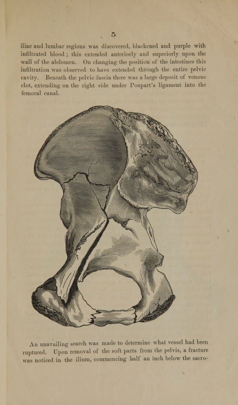 iliac and lumbar regions was discovered, blackened and purple with infiltrated blood ; tins extended anteriorly and superiorly upon the wall of the abdomen. On changing the position of the intestines this infiltration was observed to have extended through the entire pelvic cavity. Beneath the pelvic fascia there was a large deposit of venous clot, extending on the right side under Poupart's ligament into the femoral canal. An unavailing search was made to determine what vessel had been ruptured. Upon removal of the soft parts from the pelvis, a fracture was noticed in the ilium, commencing half an inch below the sacro-