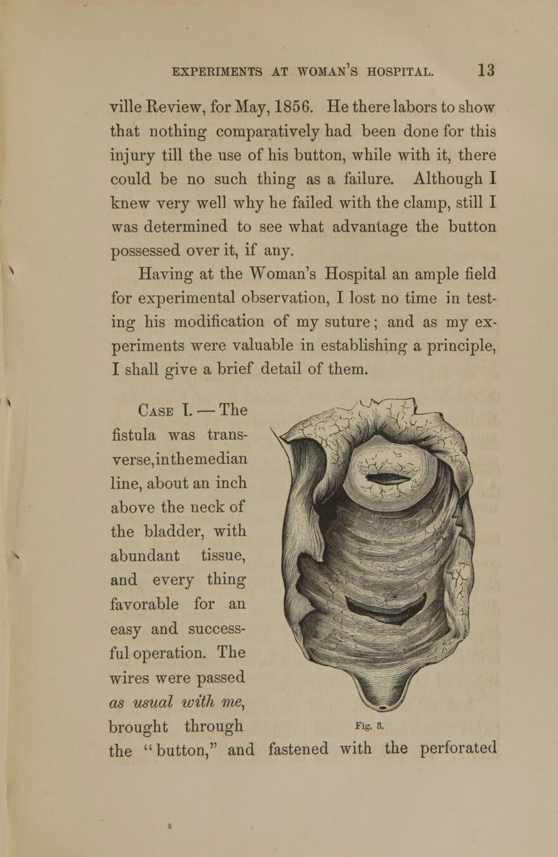 ville Review, for May, 1856. He there labors to show that nothing comparatively had been done for this injury till the use of his button, while with it, there could be no such thing as a failure. Although I knew very well why he failed with the clamp, still I was determined to see what advantage the button possessed over it, if any. Having at the Woman's Hospital an ample field for experimental observation, I lost no time in test- ing his modification of my suture; and as my ex- periments were valuable in establishing a principle, I shall give a brief detail of them. Case L —The fistula was trans- verse,inthemedian line, about an inch above the neck of the bladder, with abundant tissue, and every thing favorable for an easy and success- ful operation. The wires were passed as usual with me, brought through Fig. s. the button, and fastened with the perforated