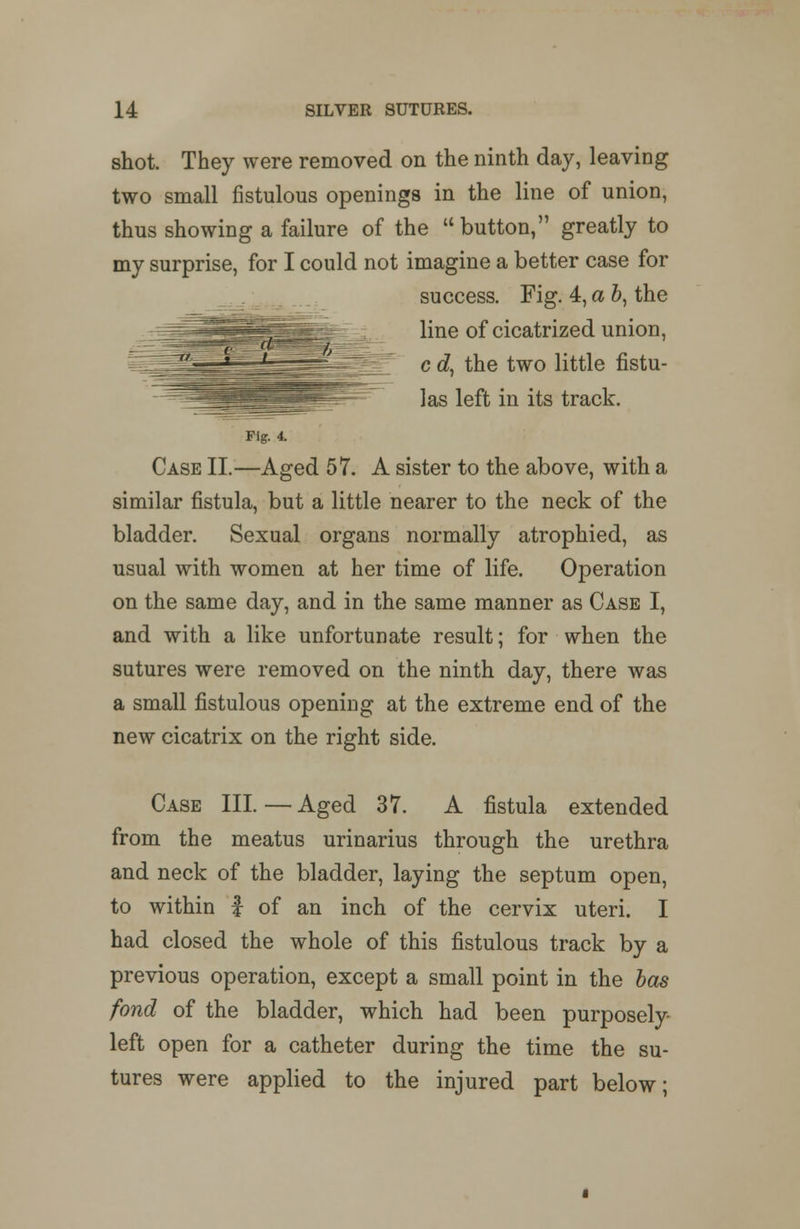 shot. They were removed on the ninth day, leaving two small fistulous openings in the line of union, thus showing a failure of the  button, greatly to my surprise, for I could not imagine a better case for success. Fig. 4, a b, the line of cicatrized union, c d, the two little fistu- las left in its track. Case II.—Aged 57. A sister to the above, with a similar fistula, but a little nearer to the neck of the bladder. Sexual organs normally atrophied, as usual with women at her time of life. Operation on the same day, and in the same manner as Case I, and with a like unfortunate result; for when the sutures were removed on the ninth day, there was a small fistulous opening at the extreme end of the new cicatrix on the right side. Case III. — Aged 37. A fistula extended from the meatus urinarius through the urethra and neck of the bladder, laying the septum open, to within f of an inch of the cervix uteri. I had closed the whole of this fistulous track by a previous operation, except a small point in the has fond of the bladder, which had been purposely- left open for a catheter during the time the su- tures were applied to the injured part below;