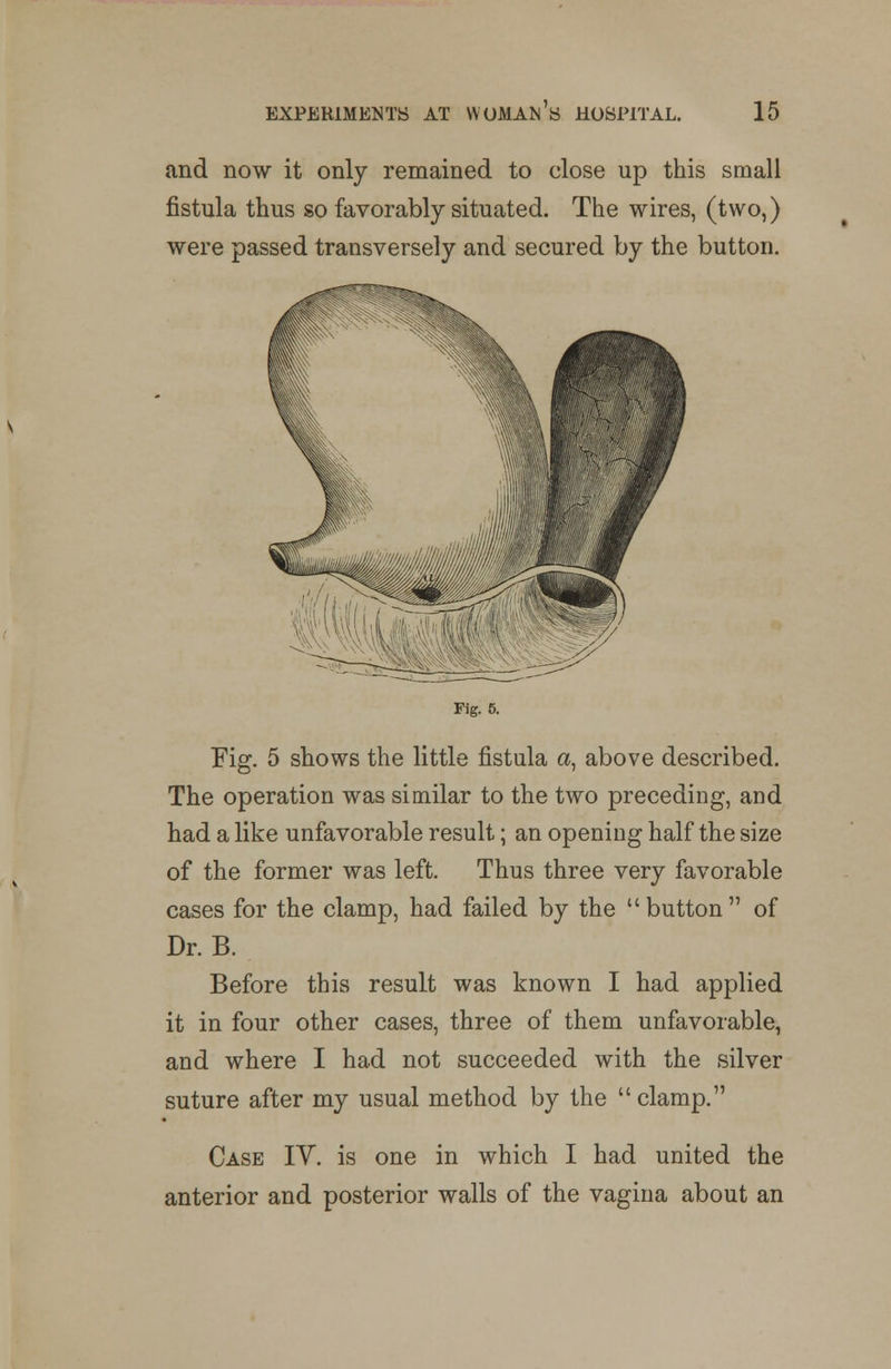 and now it only remained to close up this small fistula thus so favorably situated. The wires, (two,) were passed transversely and secured by the button. Fig. 5. Fig. 5 shows the little fistula a, above described. The operation was similar to the two preceding, and had a like unfavorable result; an opening half the size of the former was left. Thus three very favorable cases for the clamp, had failed by the button of Dr. B. Before this result was known I had applied it in four other cases, three of them unfavorable, and where I had not succeeded with the silver suture after my usual method by the clamp. Case IV. is one in which I had united the anterior and posterior walls of the vagina about an