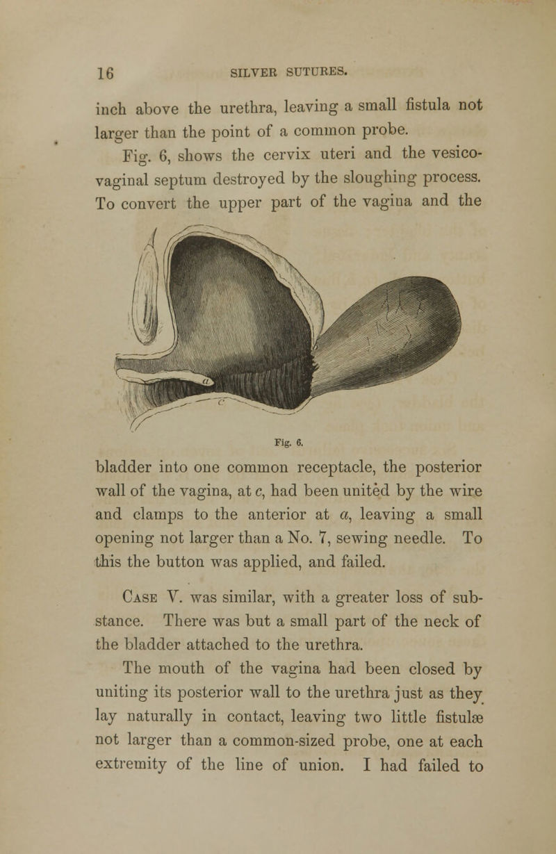 inch above the urethra, leaving a small fistula not larger than the point of a common probe. Fig. 6, shows the cervix uteri and the vesico- vaginal septum destroyed by the sloughing process. To convert the upper part of the vagina and the Fig. 6. bladder into one common receptacle, the posterior wall of the vagina, at c, had been united by the wire and clamps to the anterior at a, leaving a small opening not larger than a No. 7, sewing needle. To this the button was applied, and failed. Case V. was similar, with a greater loss of sub- stance. There was but a small part of the neck of the bladder attached to the urethra. The mouth of the vagina had been closed by uniting its posterior wall to the urethra just as they lay naturally in contact, leaving two little fistulse not larger than a common-sized probe, one at each extremity of the line of union. I had failed to
