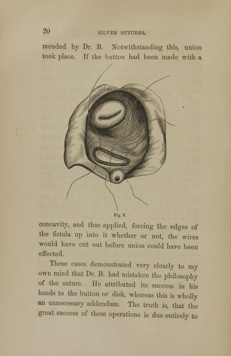 mended by Dr. B. Notwithstanding this, union took place. If the button had been made with a Fig. 9. concavity, and thus applied, forcing the edges of the fistula up into it whether or not, the wires would have cut out before union could have been effected. These cases demonstrated very clearly to my own mind that Dr. B. had mistaken the philosophy of the suture. He attributed its success in his hands to the button or disk, whereas this is wholly an unnecessary addendum. The truth is, that the great success of these operations is due entirely to