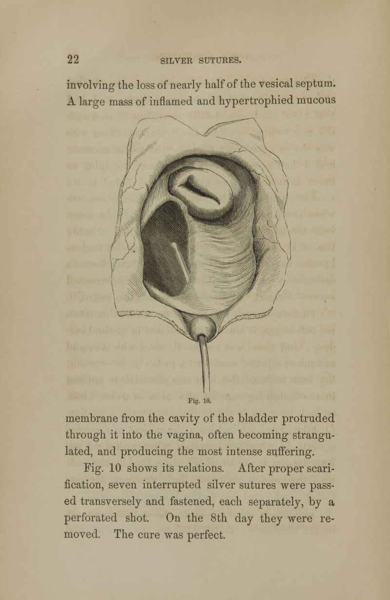 involving the loss of nearly half of the vesical septum. A large mass of inflamed and hypertrophied mucous Fig. 10. membrane from the cavity of the bladder protruded through it into the vagina, often becoming strangu- lated, and producing the most intense suffering. Fig. 10 shows its relations. After proper scari- fication, seven interrupted silver sutures were pass- ed transversely and fastened, each separately, by a perforated shot. On the 8th day they were re- moved. The cure was perfect.