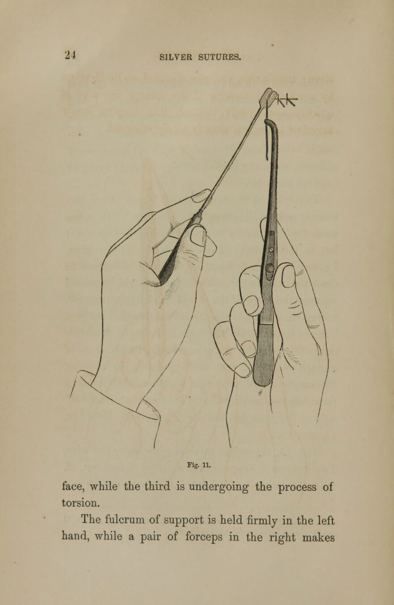 Fig. u. face, while the third is undergoing the process of torsion. The fulcrum of support is held firmly in the left hand, while a pair of forceps in the right makes