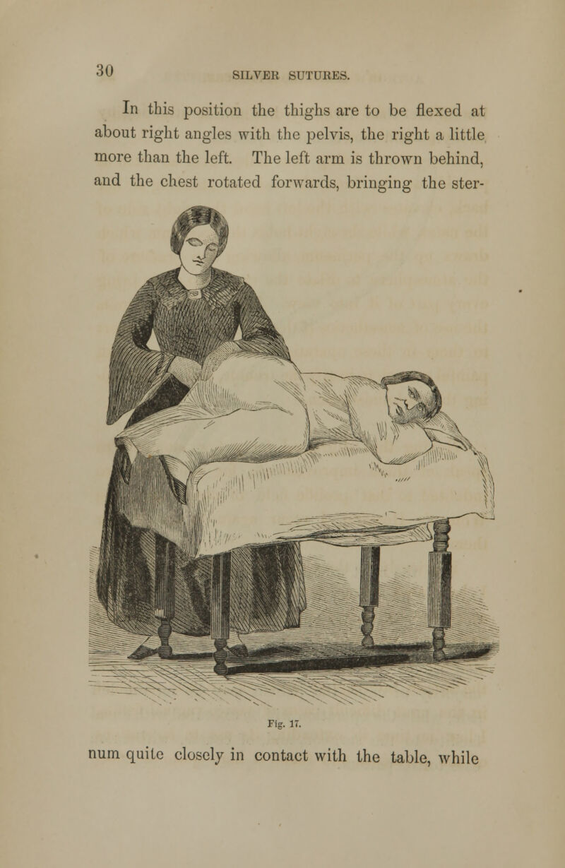SILVER SUTURES. In this position the thighs are to be flexed at about right angles with the pelvis, the right a little more than the left. The left arm is thrown behind, and the chest rotated forwards, bringing the ster- Fig. IT. num quite closely in contact with the table, while