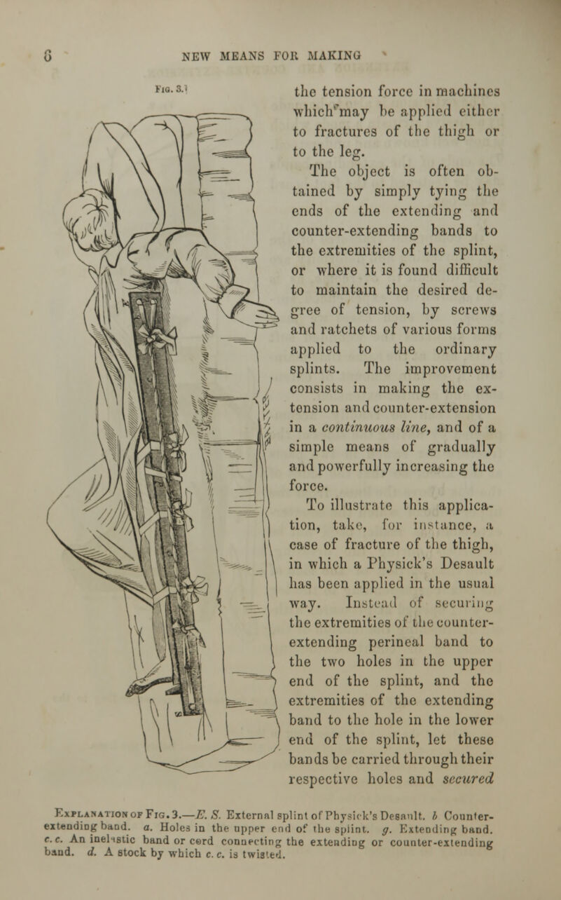 the tension force in machines which'may be applied either to fractures of the thigh or to the leg. The object is often ob- tained by simply tying the ends of the extending and counter-extending bands to the extremities of the splint, or where it is found difficult to maintain the desired de- gree of tension, by screws and ratchets of various forms applied to the ordinary splints. The improvement consists in making the ex- tension and counter-extension in a continuous line, and of a simple means of gradually and powerfully increasing the force. To illustrate this applica- tion, take, for instance, a case of fracture of the thigh, in which a Physick's Desault has been applied in the usual way. Instead of securing the extremities of the counter- extending perineal band to the two holes in the upper end of the splint, and the extremities of the extending band to the hole in the lower end of the splint, let these bands be carried through their respective holes and secured Explanation of Fig. 3.—E. S. External splint of Physick's Desanlt. b Counter- extending Dimd. a. Holes in the upper end of the spiint. g. Extending band. c.c. An inehstic band or cerd connecting the extending or counter-extending baud. d. A stock by which c.c. is twuted.