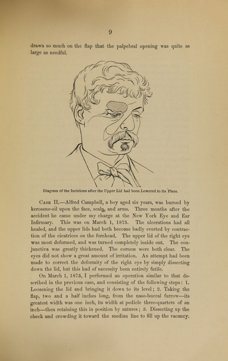 drawn so much on the flap that the palpebral opening was quite as large as needful. Diagram of the Incisions after the Upper Lid had been Lowered to its Place. Case II.—Alfred Campbell, a boy aged six years, was burned by kerosene-oil upon the face, scalp,, and arms. Three months after the accident he came under my charge at the New York Eye and Ear Infirmary. This was on March 1, 1875. The ulcerations had all healed, and the upper lids had both become badly everted by contrac- tion of the cicatrices on the forehead. The upper lid of the right eye was most deformed, and was turned completely inside out. The con- junctiva was greatly thickened. The corneae were both clear. The eyes did not show a great amount of irritation. An attempt had been made to correct the deformity of the right eye by simply dissecting down the lid, but this had of necessity been entirely futile. On March 1, 18*75, I performed an operation similar to that de- scribed in the previous case, and consisting of the following steps: 1. Loosening the lid and bringing it down to its level; 2. Taking the flap, two and a half inches long, from the naso-buccal furrow—its greatest width was one inch, its width at pedicle three-quarters of an inch—then retaining this in position by sutures ; 3. Dissecting up the cheek and crowding it toward the median line to fill up the vacancy.