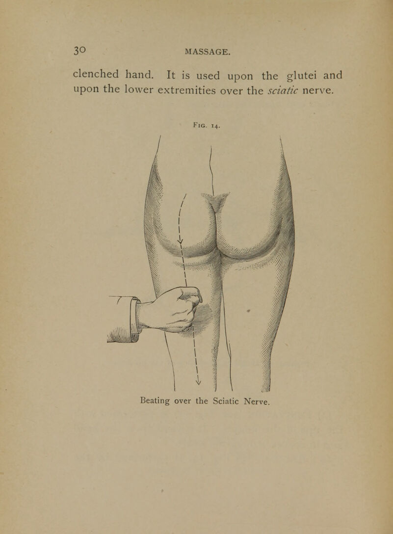 clenched hand. It is used upon the glutei and upon the lower extremities over the sciatic nerve. Fig. 14. Beating over the Sciatic Nerve.