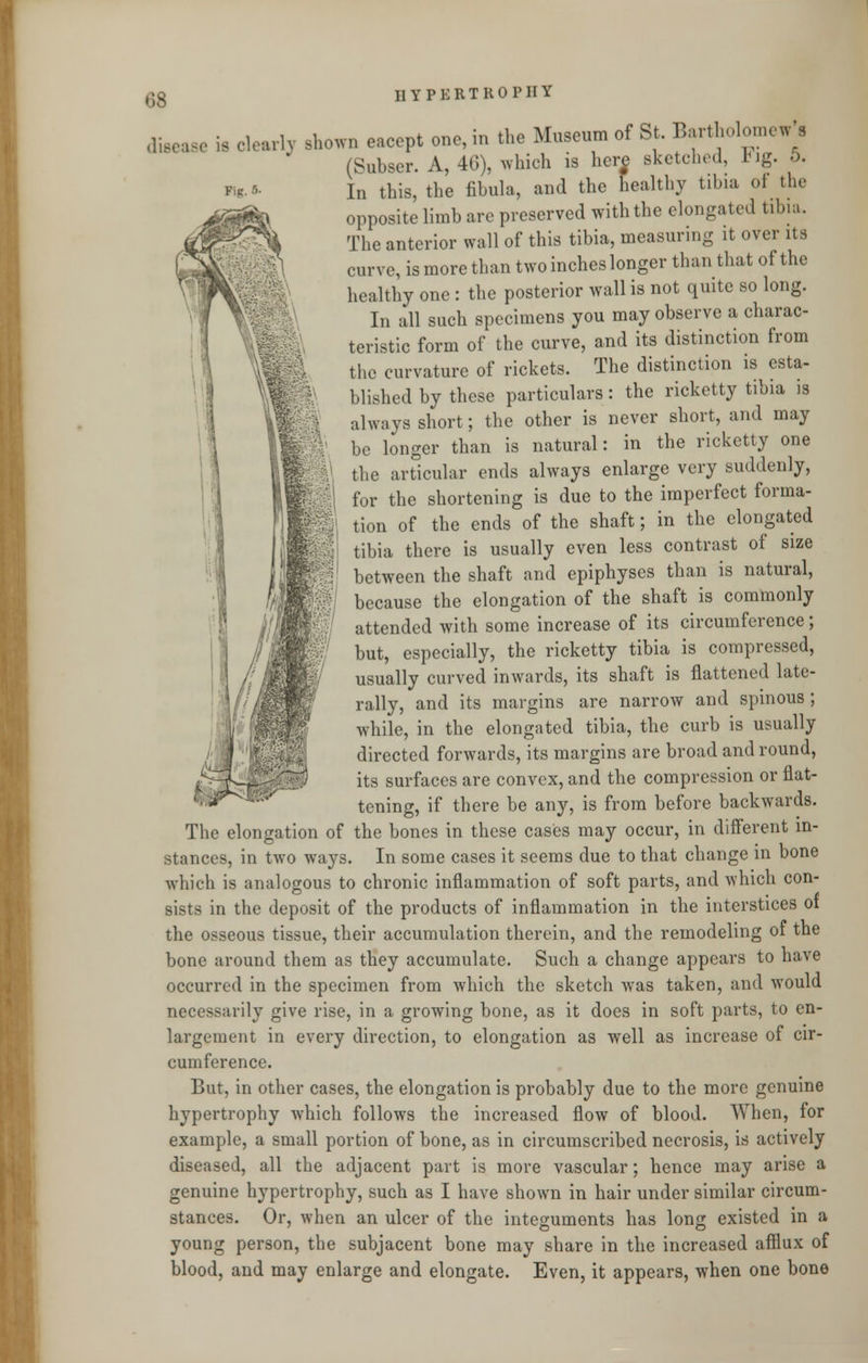 HYPERTROPHY ,. is clearly shown eaccpt one, in the Museum of St. Bartholomew^ (Subser. A, 46), which is here sketched, Fig. 5. In this, the fibula, and the healthy tibia ot tin- opposite limb are preserved with the elongated tibia. The anterior wall of this tibia, measuring it over its curve, is more than two inches longer than that of the healthy one : the posterior wall is not quite so long. In all such specimens you may observe a charac- teristic form of the curve, and its distinction from the curvature of rickets. The distinction is esta- blished by these particulars: the ricketty tibia is always short; the other is never short, and may be longer than is natural: in the ricketty one the articular ends always enlarge very suddenly, for the shortening is due to the imperfect forma- tion of the ends of the shaft; in the elongated tibia there is usually even less contrast of size between the shaft and epiphyses than is natural, because the elongation of the shaft is commonly attended with some increase of its circumference; but, especially, the ricketty tibia is compressed, usually curved inwards, its shaft is flattened late- rally, and its margins are narrow and spinous ; while, in the elongated tibia, the curb is usually directed forwards, its margins are broad and round, its surfaces are convex, and the compression or flat- tening, if there be any, is from before backwards. The elongation of the bones in these cases may occur, in different in- stances, in two ways. In some cases it seems due to that change in bone which is analogous to chronic inflammation of soft parts, and which con- sists in the deposit of the products of inflammation in the interstices of the osseous tissue, their accumulation therein, and the remodeling of the bone around them as they accumulate. Such a change appears to have occurred in the specimen from which the sketch was taken, and would necessarily give rise, in a growing bone, as it does in soft parts, to en- largement in every direction, to elongation as well as increase of cir- cumference. But, in other cases, the elongation is probably due to the more genuine hypertrophy which follows the increased flow of blood. When, for example, a small portion of bone, as in circumscribed necrosis, is actively diseased, all the adjacent part is more vascular; hence may arise a genuine hypertrophy, such as I have shown in hair under similar circum- stances. Or, when an ulcer of the integuments has long existed in a young person, the subjacent bone may share in the increased afflux of blood, and may enlarge and elongate. Even, it appears, when one bone