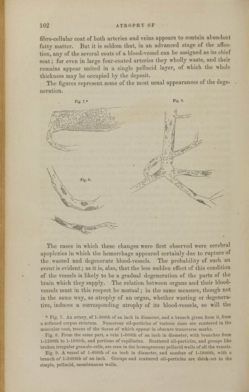 fibro-cellular coat of both arteries and veins appears to contain abundant fatty matter. But it is seldom that, in an advanced stage of the affec- tion, any of the several coats of a blood-vessel can be assigned as its chief seat; for even in large four-coated arteries they wholly waste, and their remains appear united in a single pellucid layer, of which the whole thickness may be occupied by the deposit. The figures represent some of the most usual appearances of the dege- neration. Fig. 7. Fig. 8. fi% ^- The cases in which these changes were first observed were cerebral apoplexies in which the hemorrhage appeared certainly due to rupture ol the wasted and degenerate blood-vessels. The probability of such an event is evident; as it is, also, that the less sudden effect of this condition of the vessels is likely to be a gradual degeneration of the parts of the brain which they supply. The relation between organs and their blood- vessels must in this respect be mutual; in the same measure, though not in the same way, as atrophy of an organ, whether wasting or degenera- tive, induces a corresponding atrophy of its blood-vessels, so will the * Fig. 7. An artery, of l-300th of an inch in diameter, and a branch given from it, from a softened corpus striatum. Numerous oil-particles of various sizes are scattered in the muscular coat, traces of the tissue of which appear in obscure transverse marks. Fig. 8. From the same part, a vein l-600th of an inch in diameter, with branches from l-1200th to l-1800th, and portions of capillaries. Scattered oil-particles, and groups like broken irregular granule-cells, are seen in the homogeneous pellucid walls of all the vessels. Eig. 9. A vessel of l-600tb of an inch in diameter, and another of l-1800th, with a branch of l-3000th of an inch. Groups and scattered oil-particles are thick-set in the simple, pellucid, membranous walls.