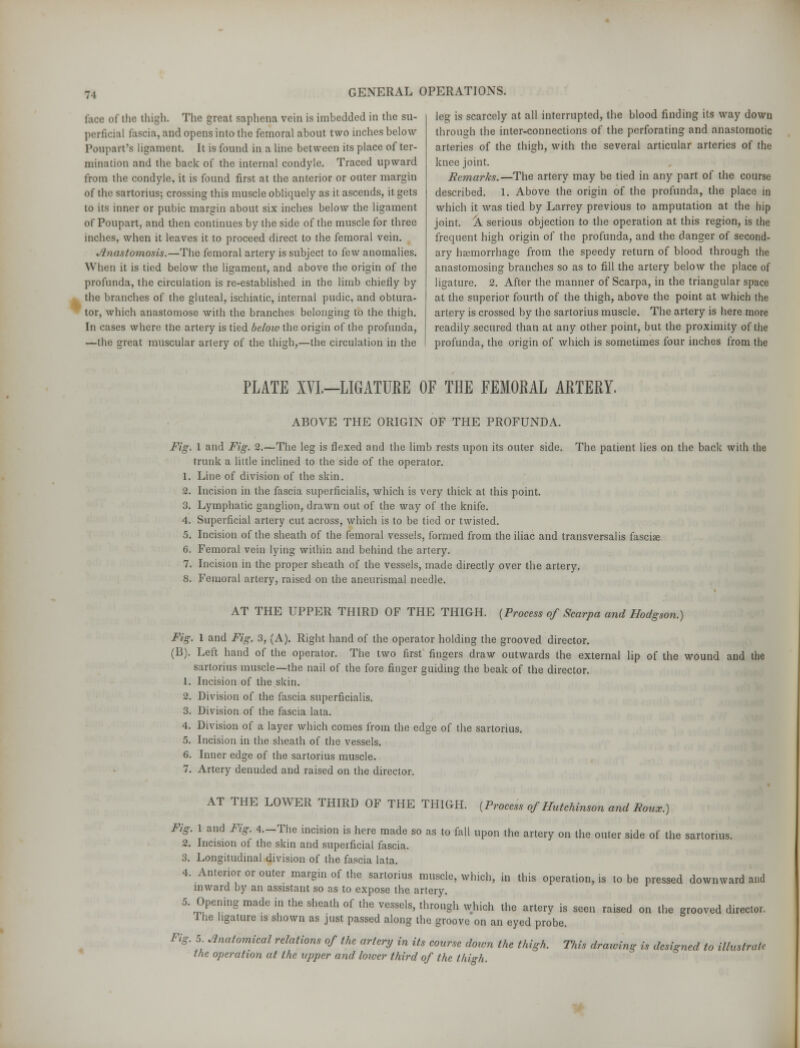 face of the thigh. The great saphena vein is imbedded in the su- perficial fascia, and opens into the femoral about two inches below Ponpart's ligament. It is found in a line between its place of ter- mination and the back of the internal condyle. Traced upward from the condyle, it is found first at the anterior or outer margin of the sartorius; crossing this muscle oblkpaely as it ascends, it gets to its inner or pubic margin about six inches below the ligament of Poupart, and then continues by the side of the muscle for three inches, when it leaves it to proceed direct to the femoral vein. Anastomosis.—The femoral artery is subject to few anomalies. When it is tied below the ligament, and above the origin of the profunda, the circulation is re-established in the limb chiefly by the branches of the gluteal, ischiatic, internal pudic, and obtura- tor, which anastomose with the branches belonging to the thigh. In cases where the artery is tied beloio the origin of the profunda, —the great muscular artery of the thigh,—the circulation in the Jeg is scarcely at all interrupted, the blood finding its way down throush the inter-connections of the perforating and anastomotic arteries of the thigh, with the several articular arteries of the knee joint. Remarks.—The artery may be tied in any part of the course described. 1. Above the origin of the profunda, the place in which it was tied by Larrey previous to amputation at the hip joint. A serious objection to the operation at this region, is the frequent high origin of the profunda, and the danger of second- ary hsemorrhage from the speedy return of blood through the anastomosing branches so as to fill the artery below the place of ligature. 2. After the manner of Scarpa, in the triangular space at the superior fourth of the thigh, above the point at which the artery is crossed by the sartorius muscle. The artery is here more readily secured than at any other point, but the proximity of the profunda, the origin of which is sometimes four inches from the PLATE XVL—LIGATURE OF THE FEMORAL ARTERY. ABOVE THE ORIGIN OF THE PROFUNDA. Fig. 1 and Fig. 2.—The leg is flexed and the limb rests upon its outer side. The patient lies on the back with the trunk a little inclined to the side of the operator. 1. Line of division of the skin. 2. Incision in the fascia superficialis, which is very thick at this point. 3. Lymphatic ganglion, drawn out of the way of the knife. 4. Superficial artery cut across, which is to be tied or twisted. 5. Incision of the sheath of the femoral vessels, formed from the iliac and transversalis fascia 6. Femoral vein lying within and behind the artery. 7. Incision in the proper sheath of the vessels, made directly over the artery. 8. Femoral artery, raised on the aneurismal needle. AT THE UPPER THIRD OF THE THIGH. (Process of Scarpa and Hodgson.) Fig. 1 and Fig. 3, (A). Right hand of the operator holding the grooved director. (B). Left hand of the operator. The two first fingers draw outwards the external lip of the wound and the sartorius muscle—the nail of the fore finger guiding the beak of the director. 1. Incision of the skin. 2. Division of the fascia superficialis. 3. Division of the fascia lata. 4. Division of a layer which comes from the edge of the sartorius. 5. Incision in the sheath of the vessels. 6. Inner edge of the sartorius muscle. 7. Artery denuded and raised on the director. AT THE LOWER THIRD OF THE THIGH. (Process of Hutchinson and Boux.) Fig. 1 and Fig. 4.-The incision is here made so as to fall upon the artery on the outer side of the sartorius. 2. Incision oi the skin and superficial fascia. 3. Longitudinal division of the fascia lata. 4. Anterior or outer margin of the sartorius muscle, which, in this operation, is to be pressed downward and inward by an assistant so as to expose the artery. 5. Opening made in the sheath of the vessels, through which the arterv is seen raised on the grooved director. I he ligature is shown as just passed along the groove on an eyed probe. Fig. 5 Anatomical relations of the artery in its course doivn the thigh. This drawing is designed to illustrate the operation at the tipper and lower third of the thi-h.