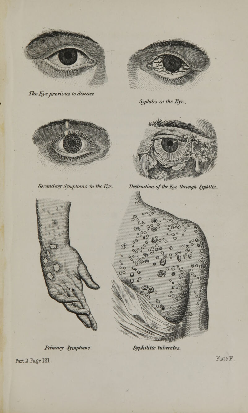 The Kvrprevious to disease Sspkfibti in the Eye. Stcandwy Spnploms in the Eye, DestrwHcm of the Eye Dntmgh Syphilis. Primary Symptoms. Part 2.Page 121 Sf])fii/itf'c ttibervles. Plate F.