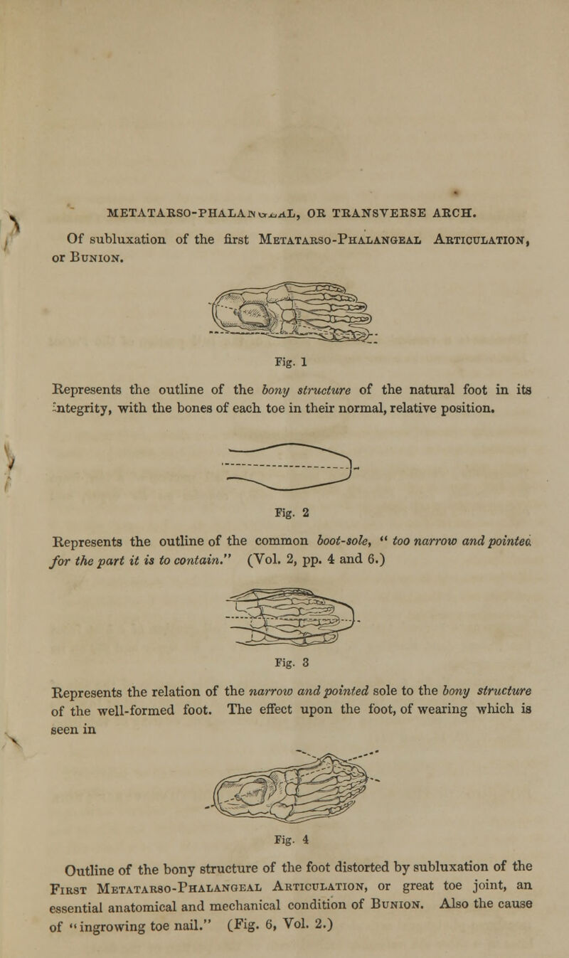 METATAKSO-PHALAJN cr^AL, OR TKANSVERSE AECH. Of subluxation of the first Metatarso-Phalangeal Aeticulation, or Bunion. Fig. 1 Represents the outline of the bony structure of the natural foot in its integrity, with the bones of each toe in their normal, relative position. rig. 2 Represents the outline of the common boot-sole,  too narrow and pointeo. for the part it is to contain. (Vol. 2, pp. 4 and 6.) Fig. 3 Represents the relation of the narroto and pointed sole to the bony structure of the well-formed foot. The effect upon the foot, of wearing which is Fig- 4 Outline of the bony structure of the foot distorted by subluxation of the First Metatarso-Phalangeal Articulation, or great toe joint, an essential anatomical and mechanical condition of Bunion. Also the cause of ingrowing toe nail. (Fig. 6, Vol. 2.)